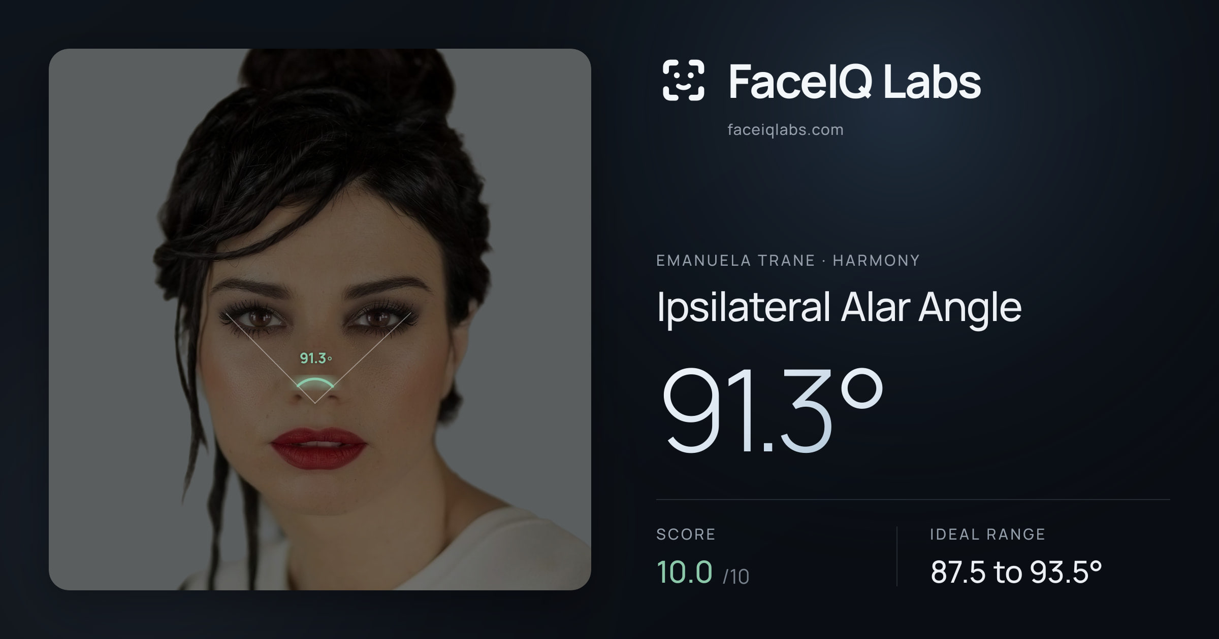 Emanuela Trane Ipsilateral Alar Angle: 91.3°, drawn on the photo