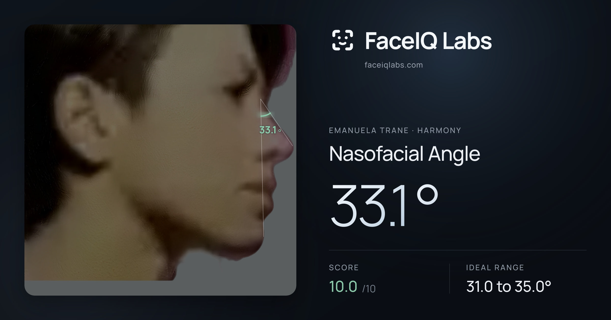 Emanuela Trane Nasofacial Angle: 33.1°, drawn on the photo