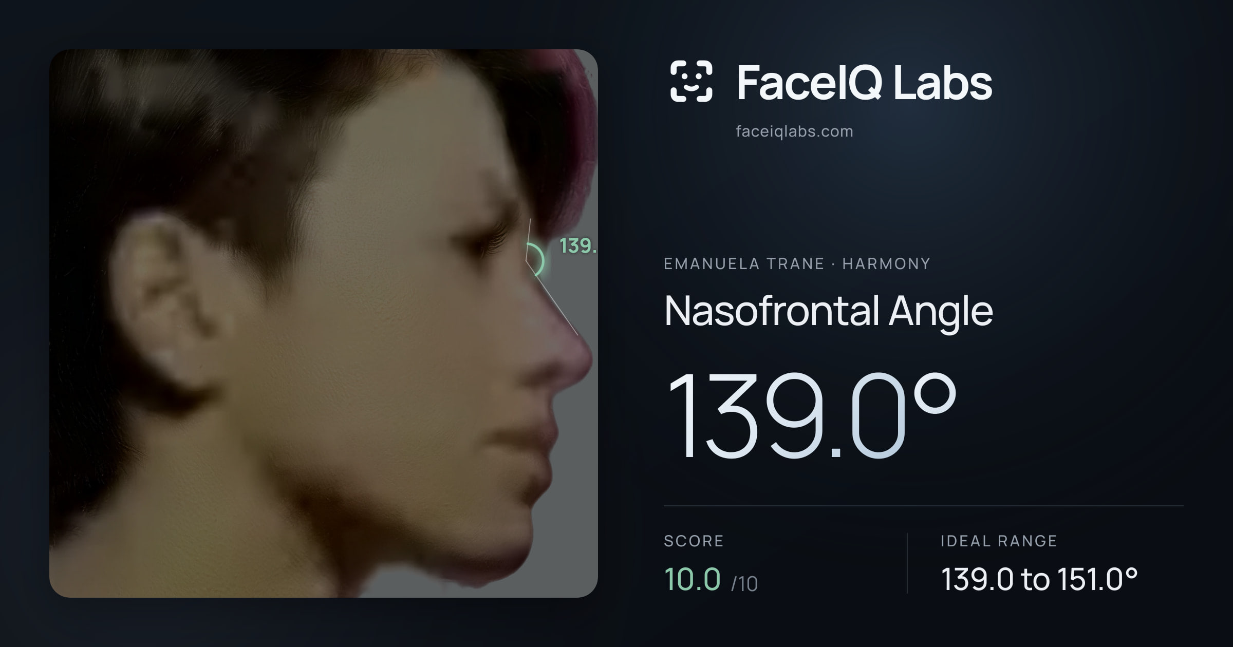 Emanuela Trane Nasofrontal Angle: 139.0°, drawn on the photo