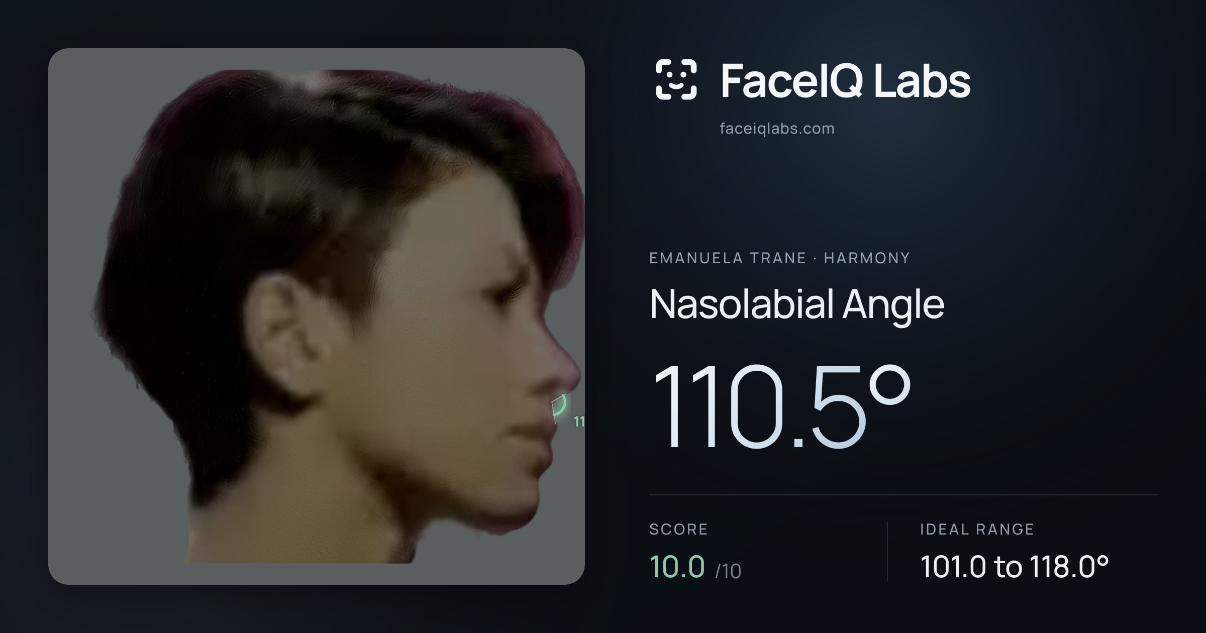 Emanuela Trane Nasolabial Angle: 110.5°, drawn on the photo