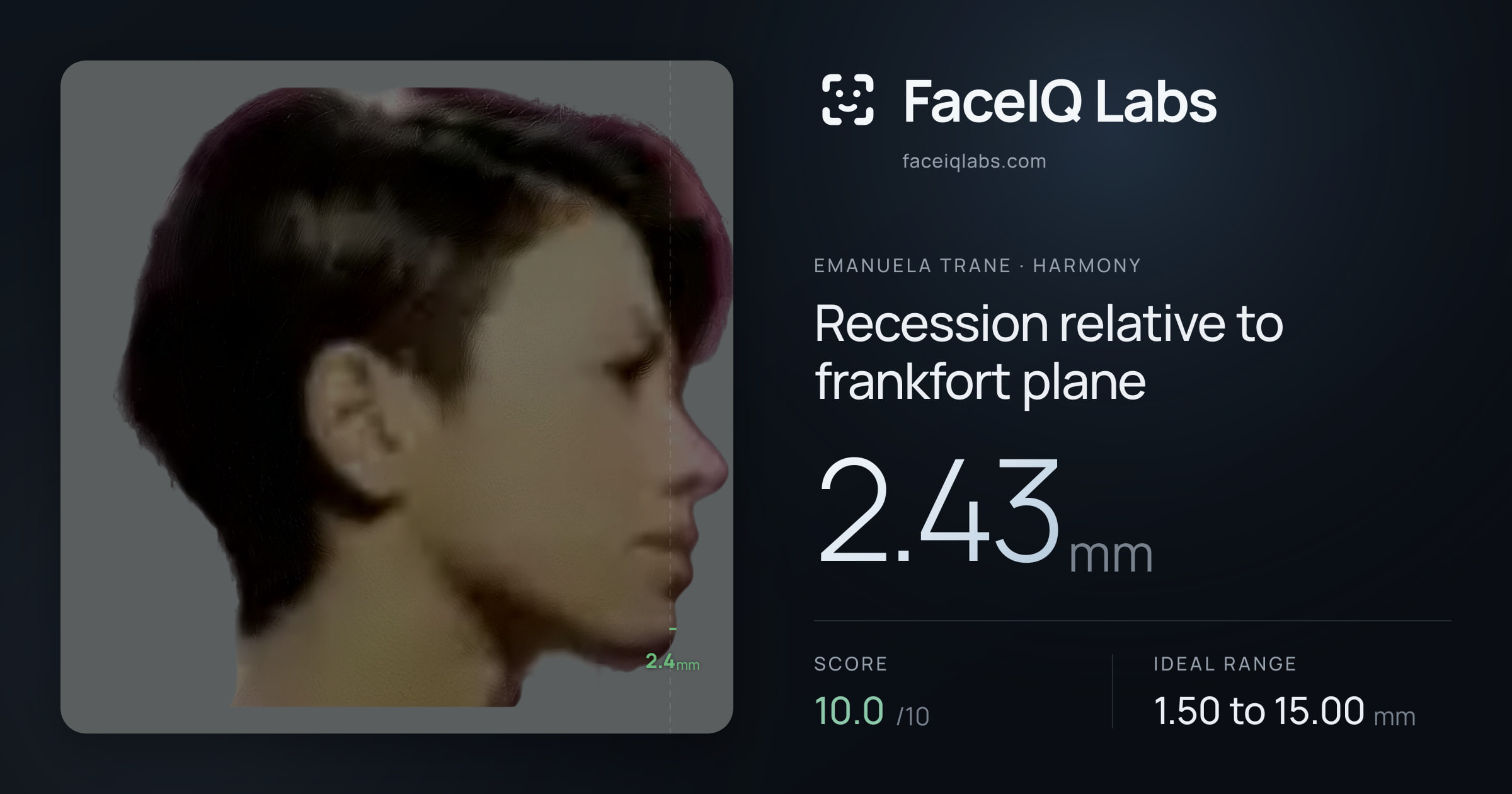 Emanuela Trane Recession relative to frankfort plane: 2.43mm, drawn on the photo