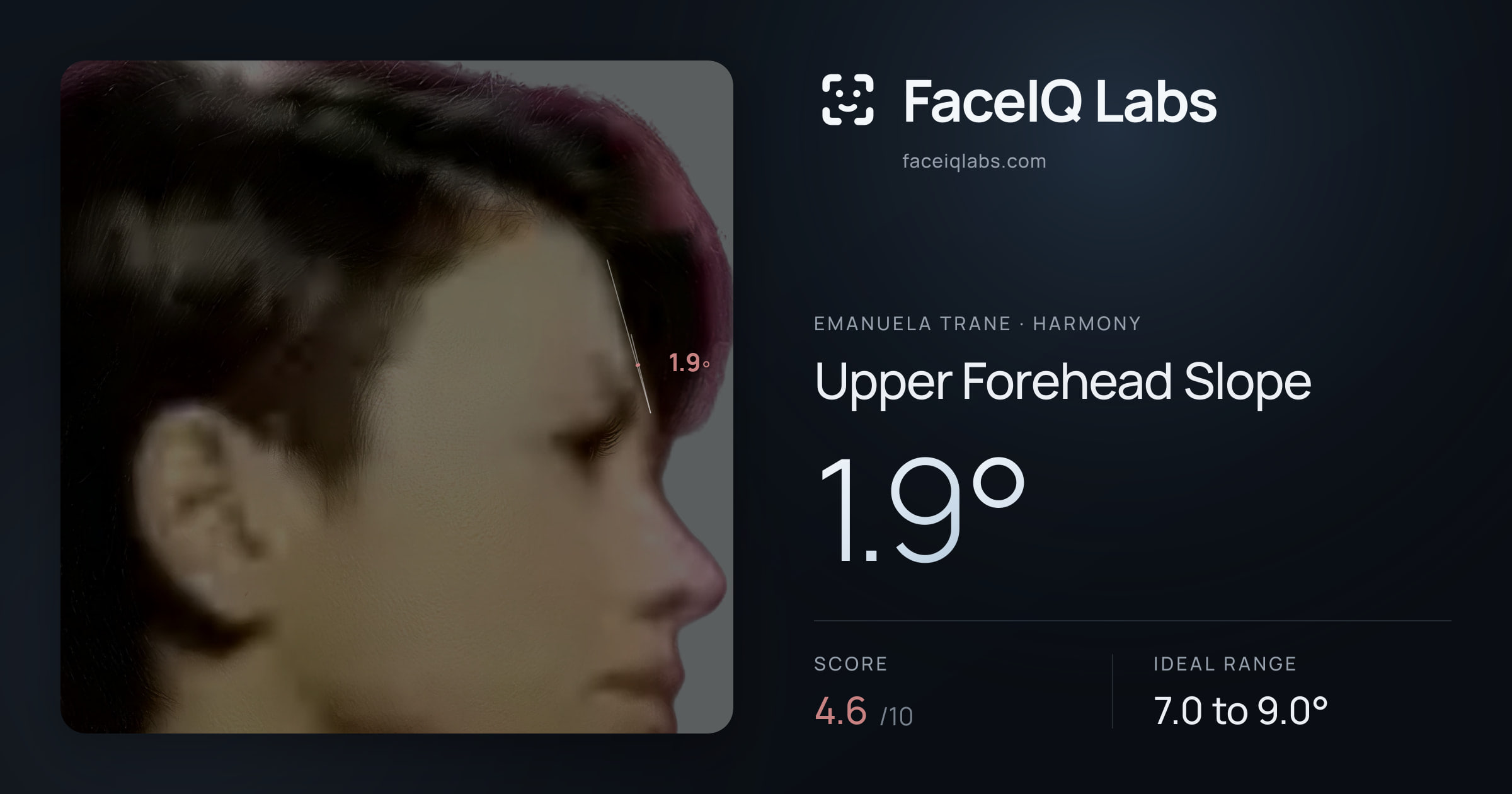 Emanuela Trane Upper Forehead Slope: 1.9°, drawn on the photo