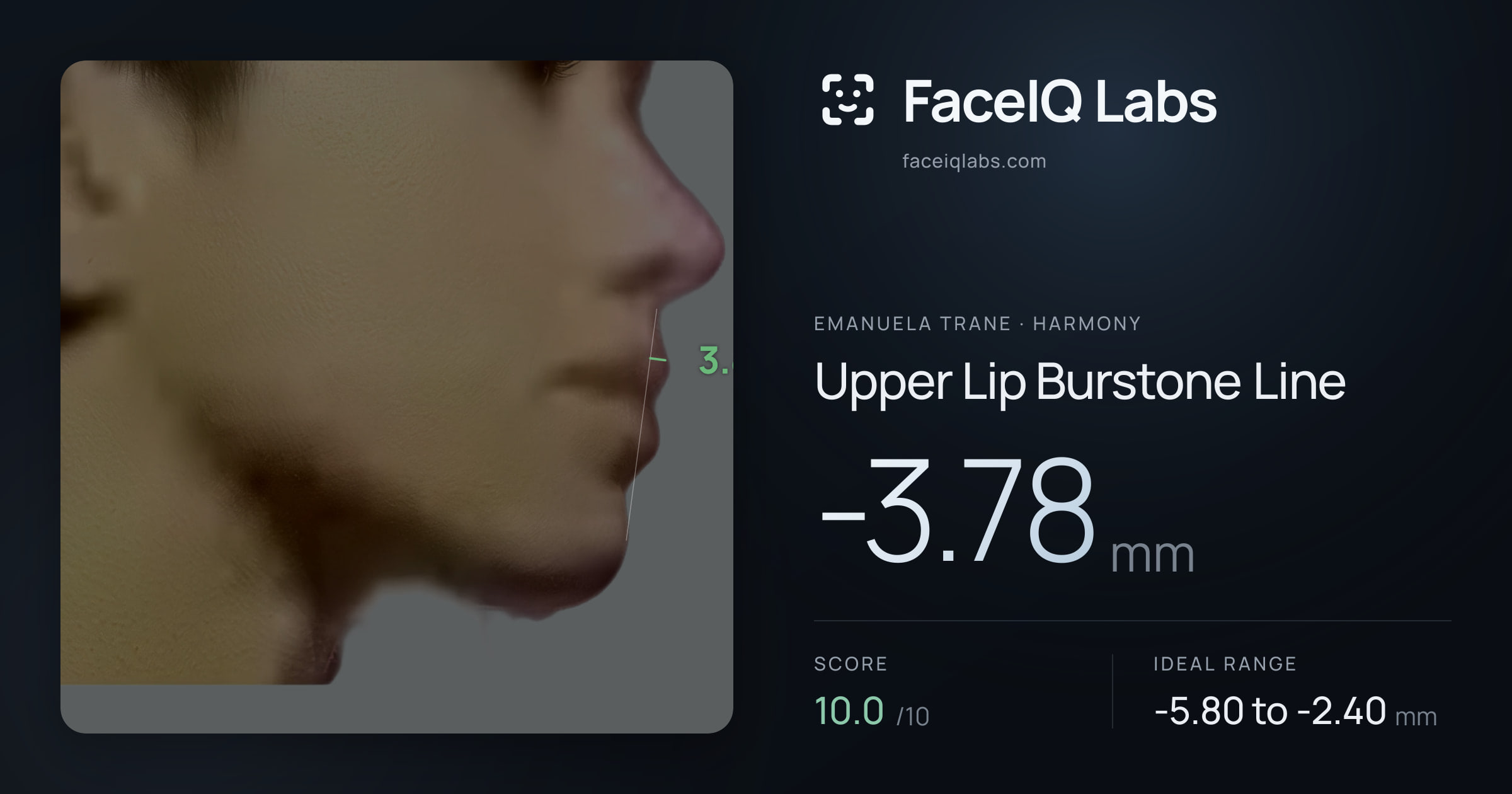 Emanuela Trane Upper Lip Burstone Line: -3.78mm, drawn on the photo