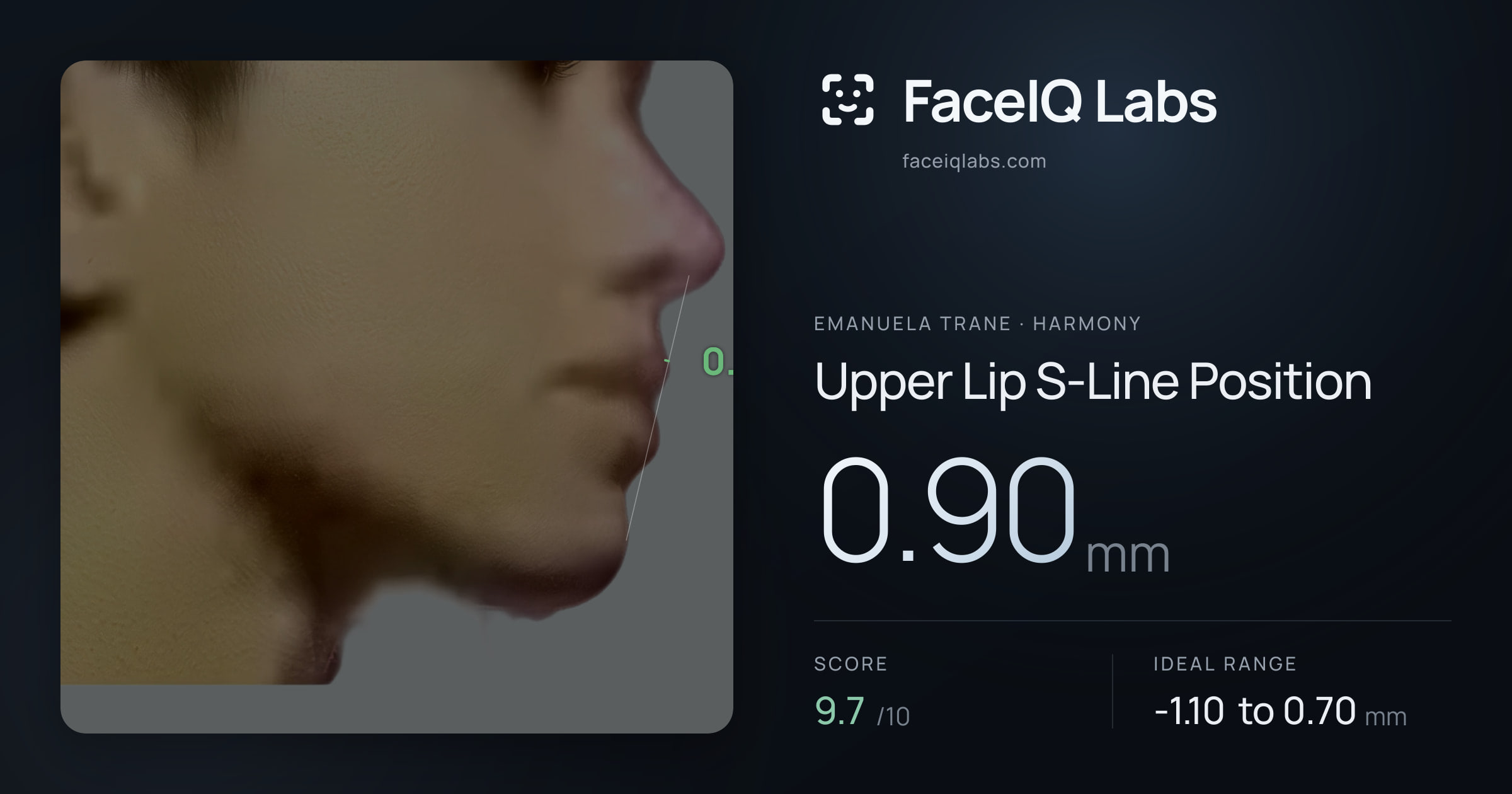 Emanuela Trane Upper Lip S-Line Position: 0.90mm, drawn on the photo