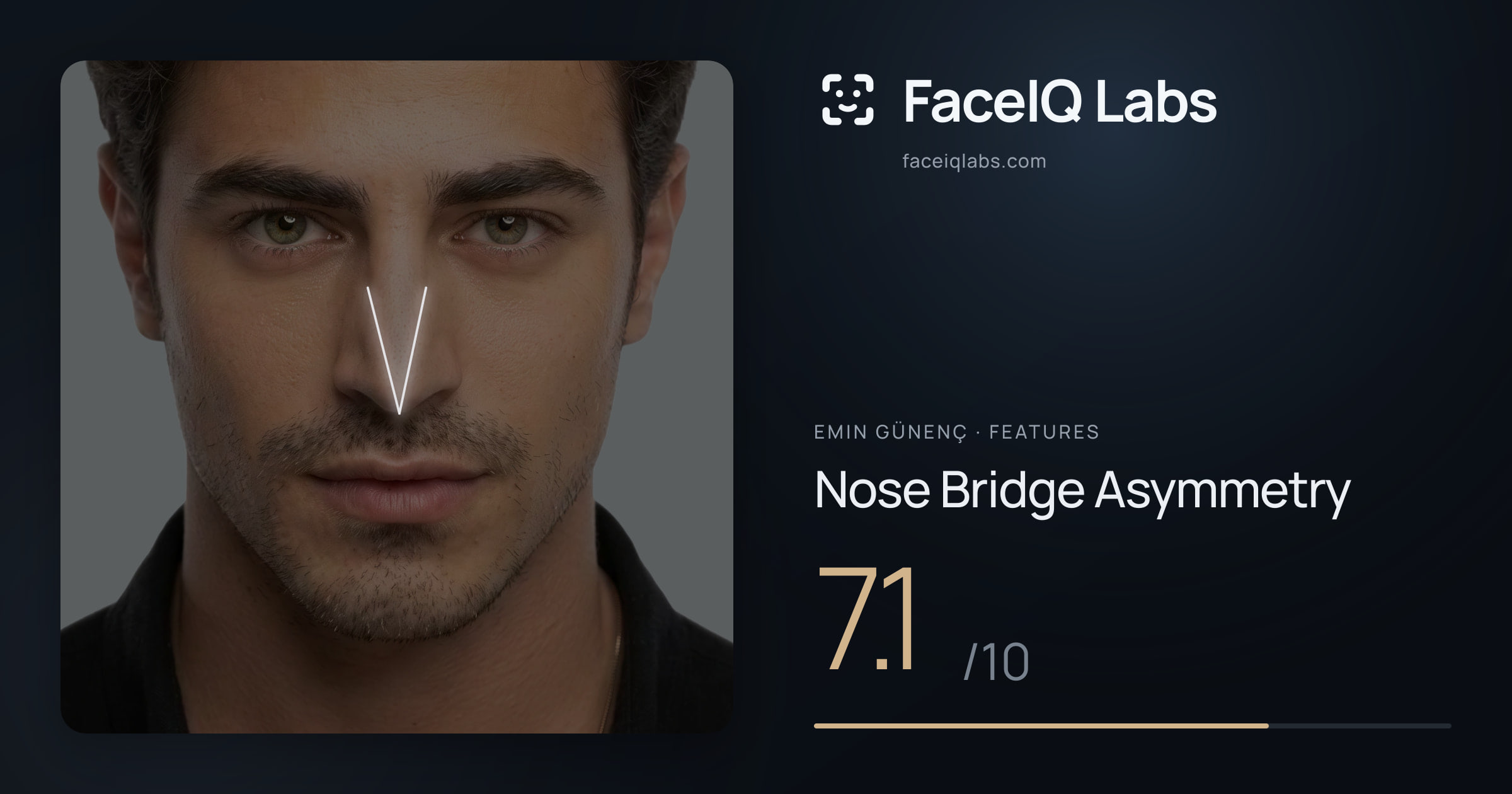 Emin Günenç Nose Bridge Asymmetry: 7.1/10, drawn on the photo