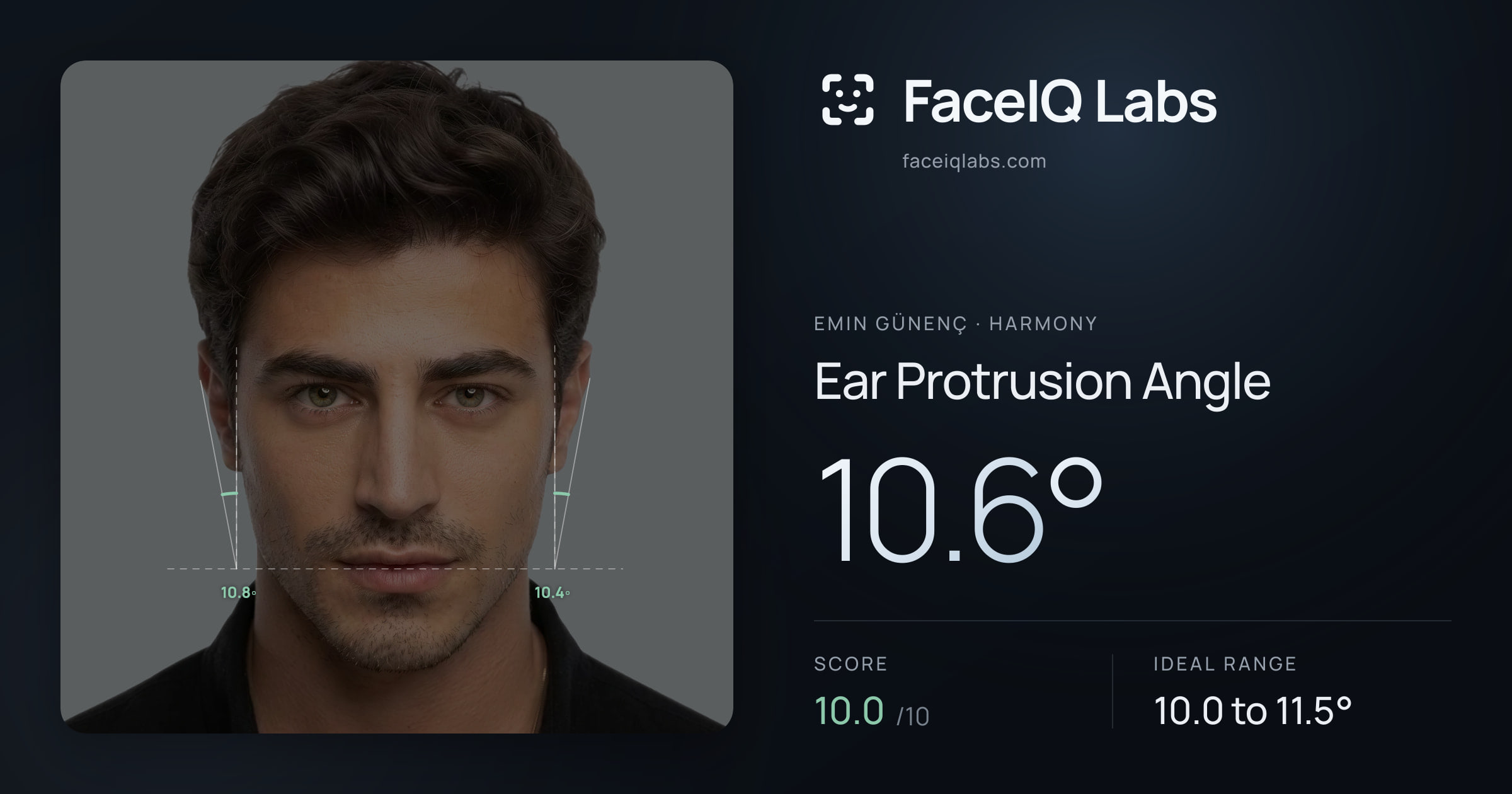 Emin Günenç Ear Protrusion Angle: 10.6°, drawn on the photo