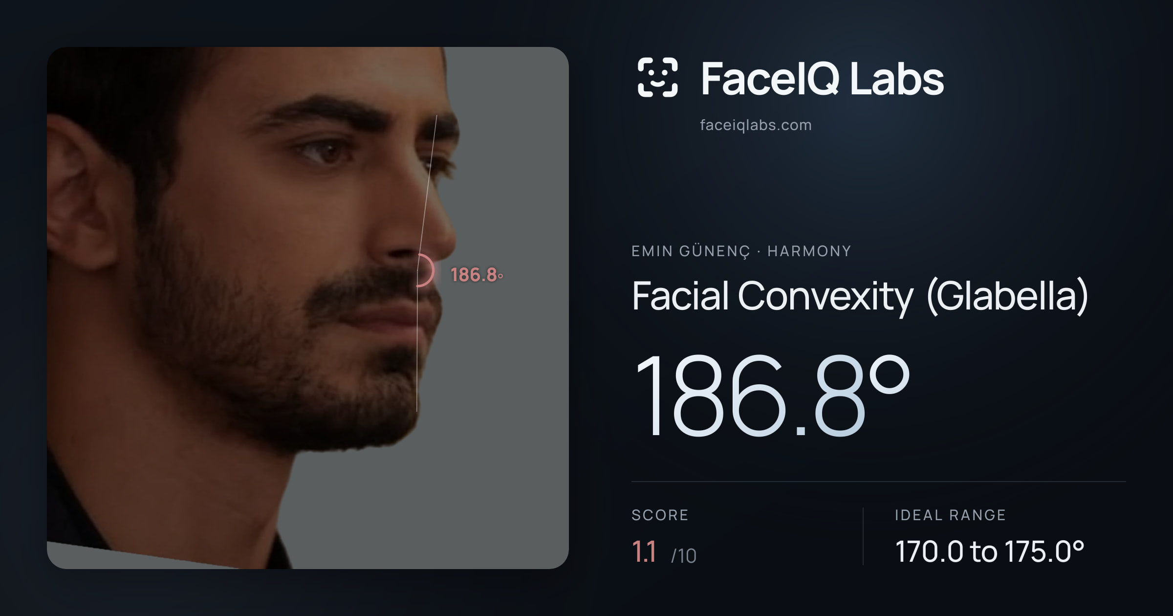 Emin Günenç Facial Convexity (Glabella): 186.8°, drawn on the photo