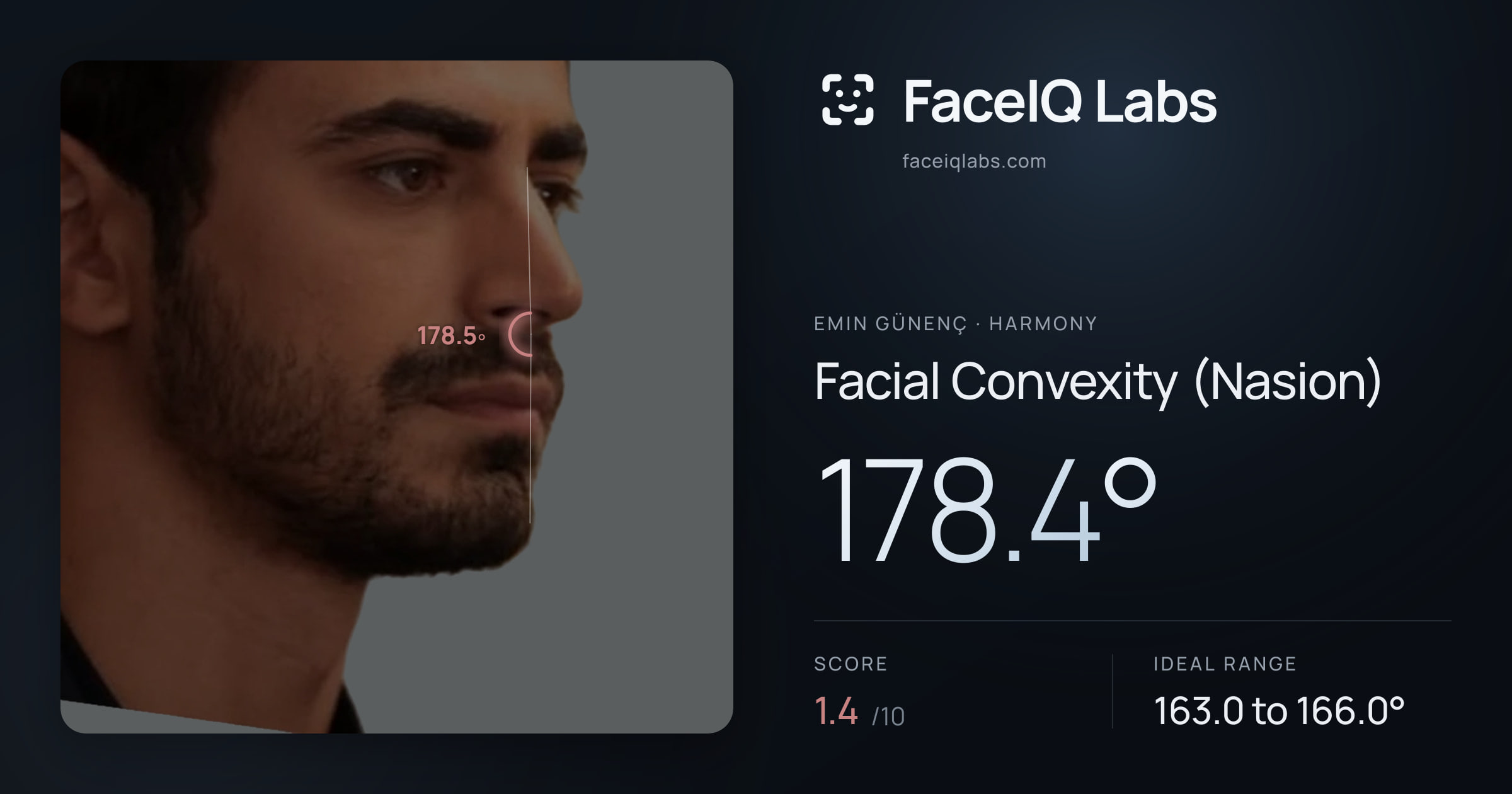 Emin Günenç Facial Convexity (Nasion): 178.4°, drawn on the photo