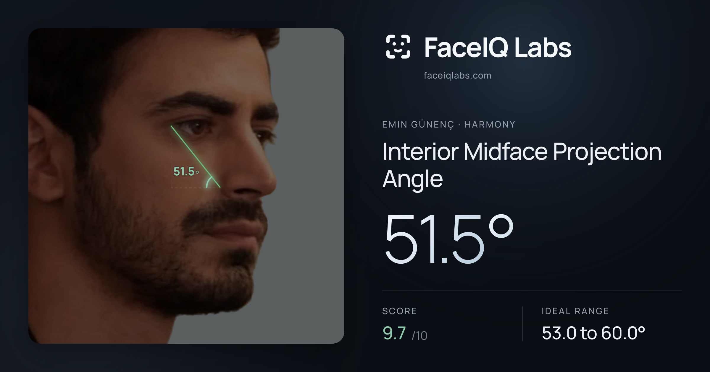 Emin Günenç Interior Midface Projection Angle: 51.5°, drawn on the photo