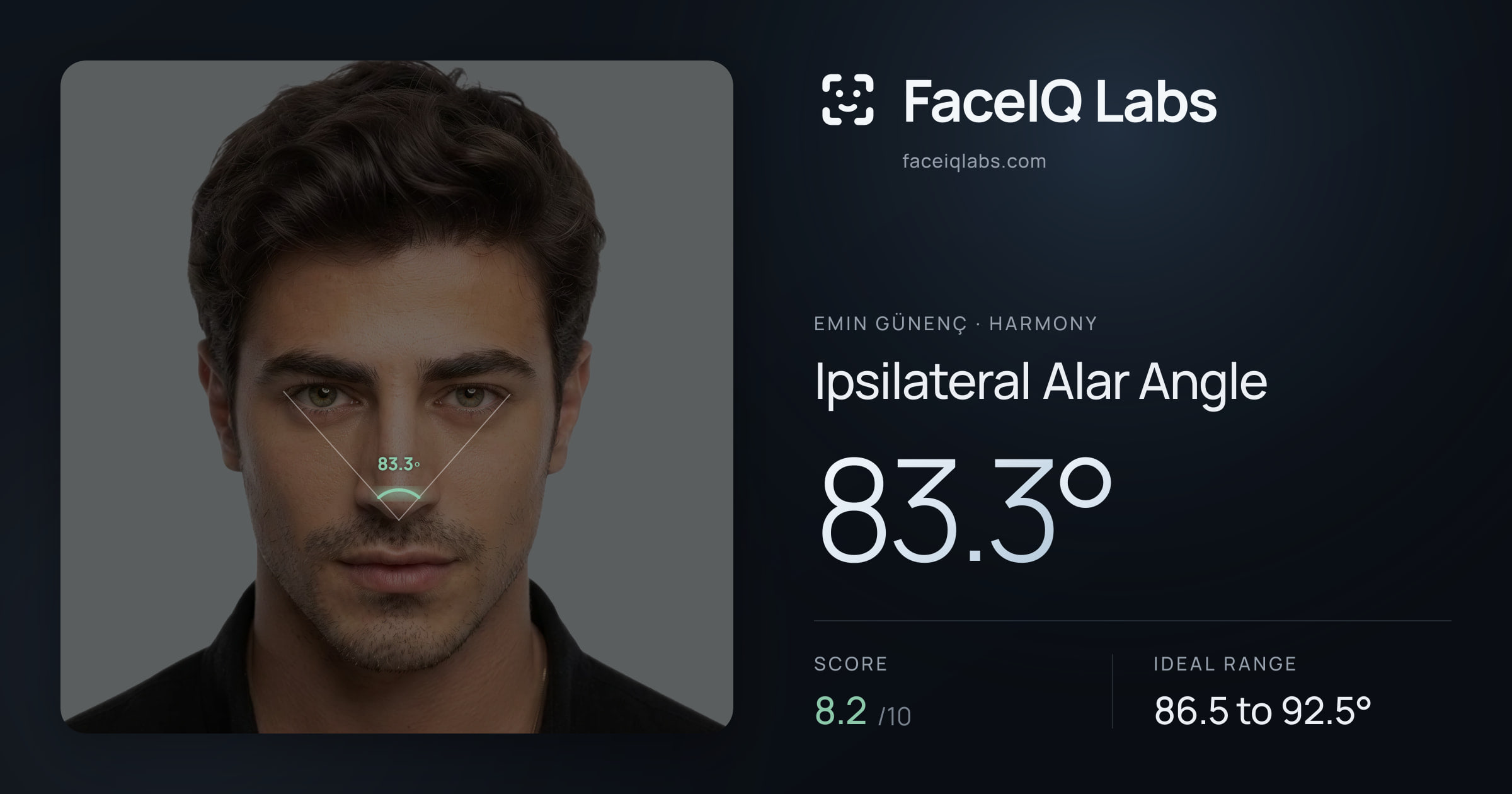 Emin Günenç Ipsilateral Alar Angle: 83.3°, drawn on the photo