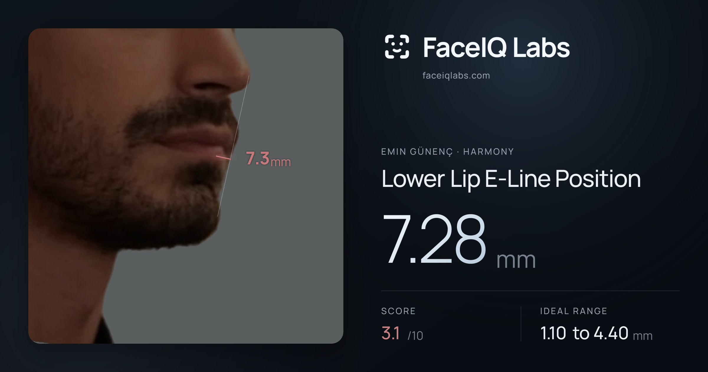 Emin Günenç Lower Lip E-Line Position: 7.28mm, drawn on the photo