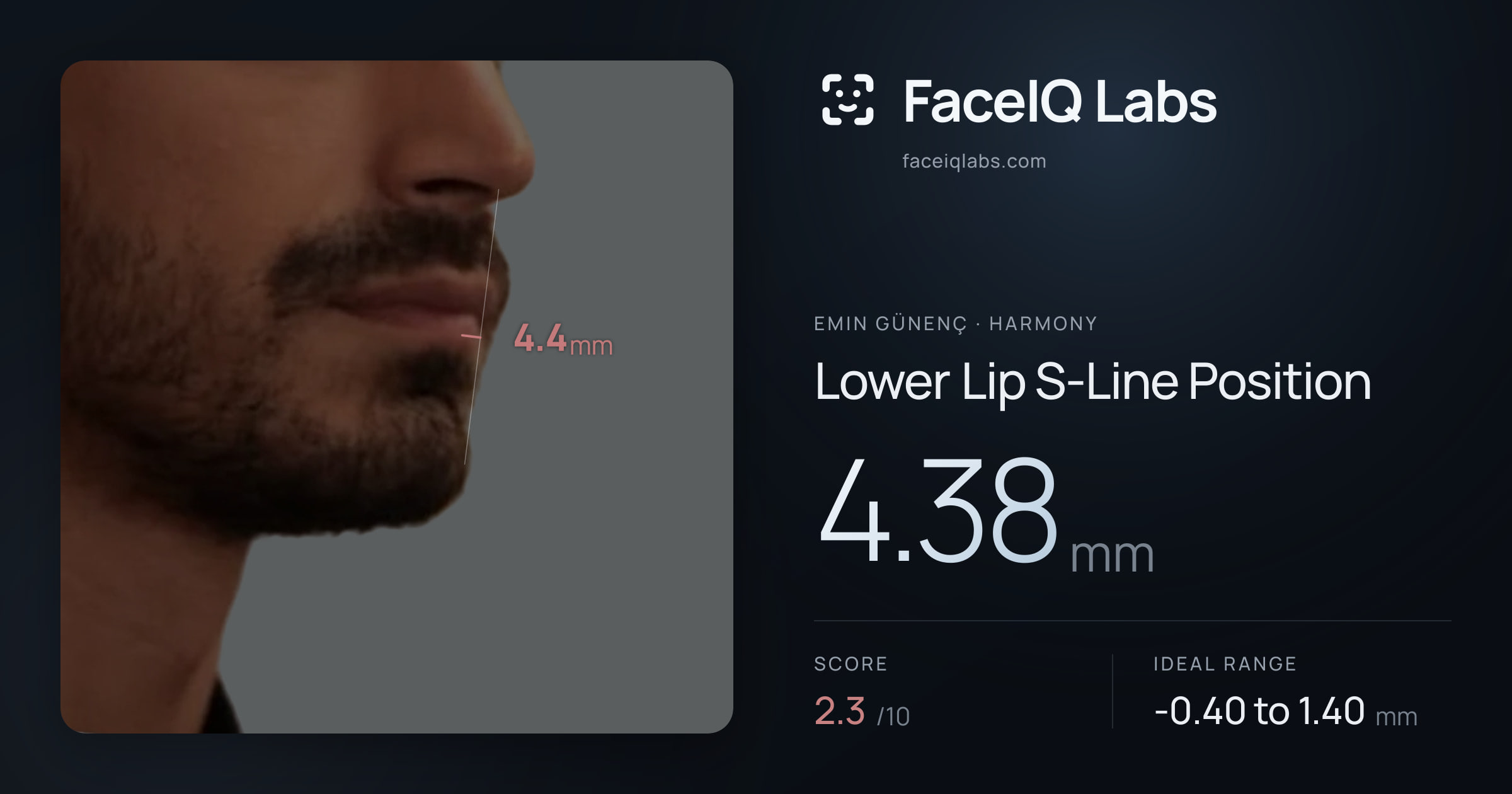 Emin Günenç Lower Lip S-Line Position: 4.38mm, drawn on the photo