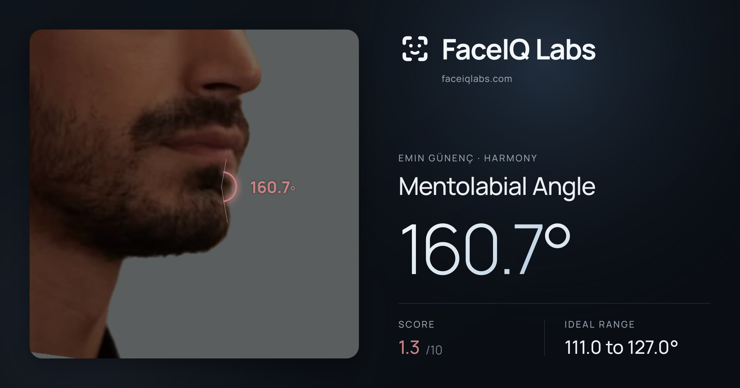 Emin Günenç Mentolabial Angle: 160.7°, drawn on the photo