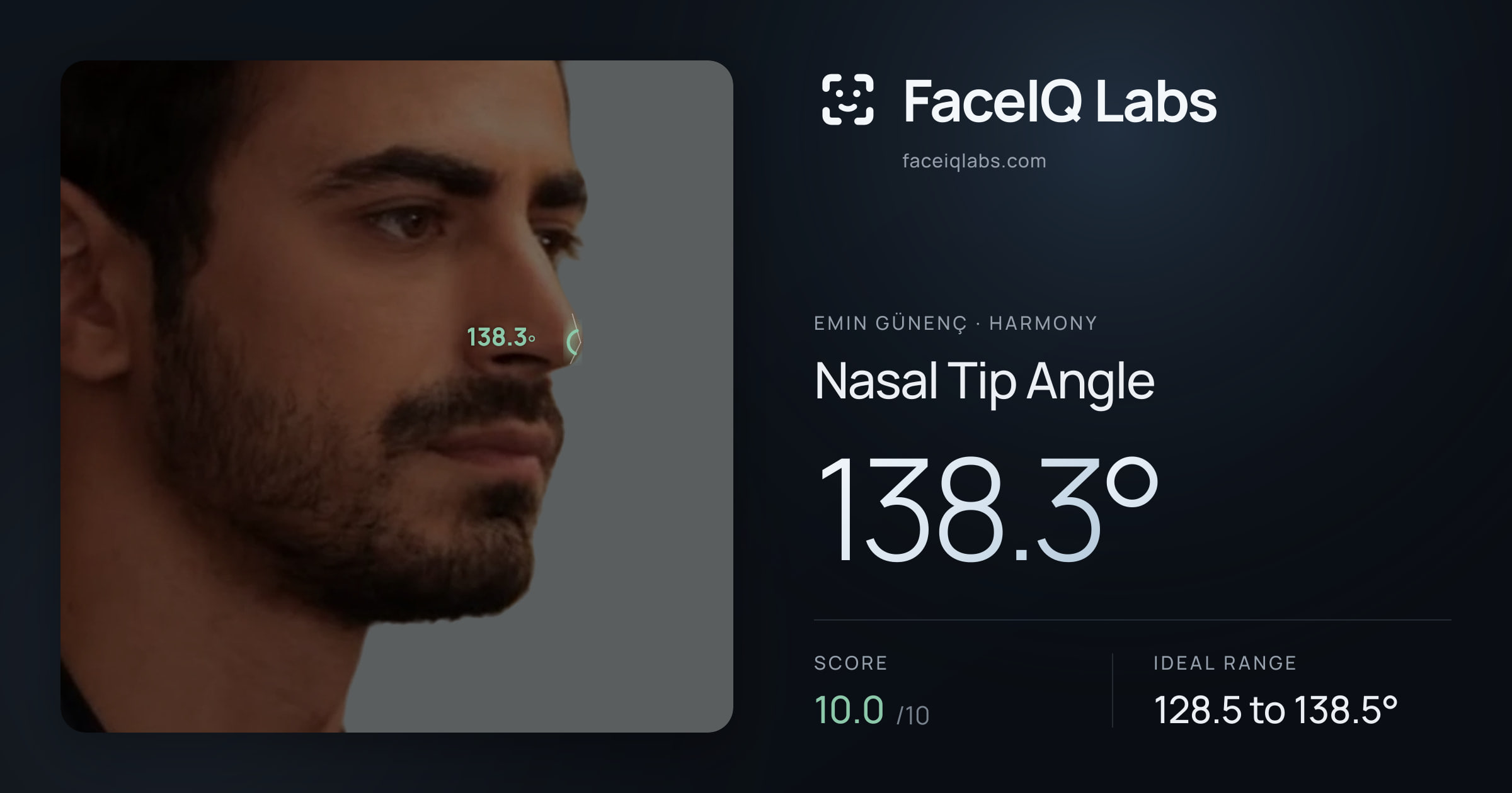 Emin Günenç Nasal Tip Angle: 138.3°, drawn on the photo