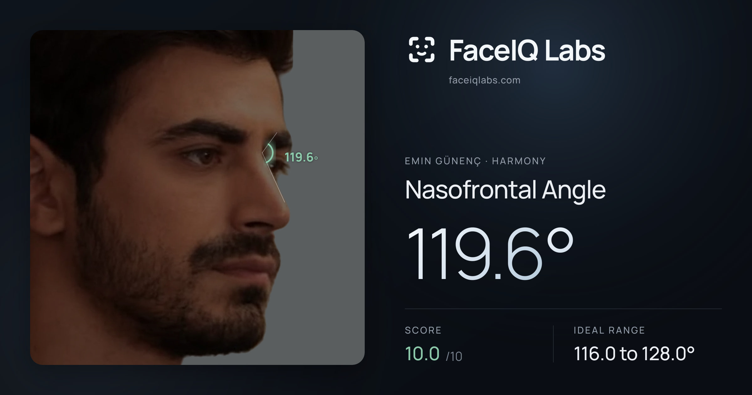 Emin Günenç Nasofrontal Angle: 119.6°, drawn on the photo
