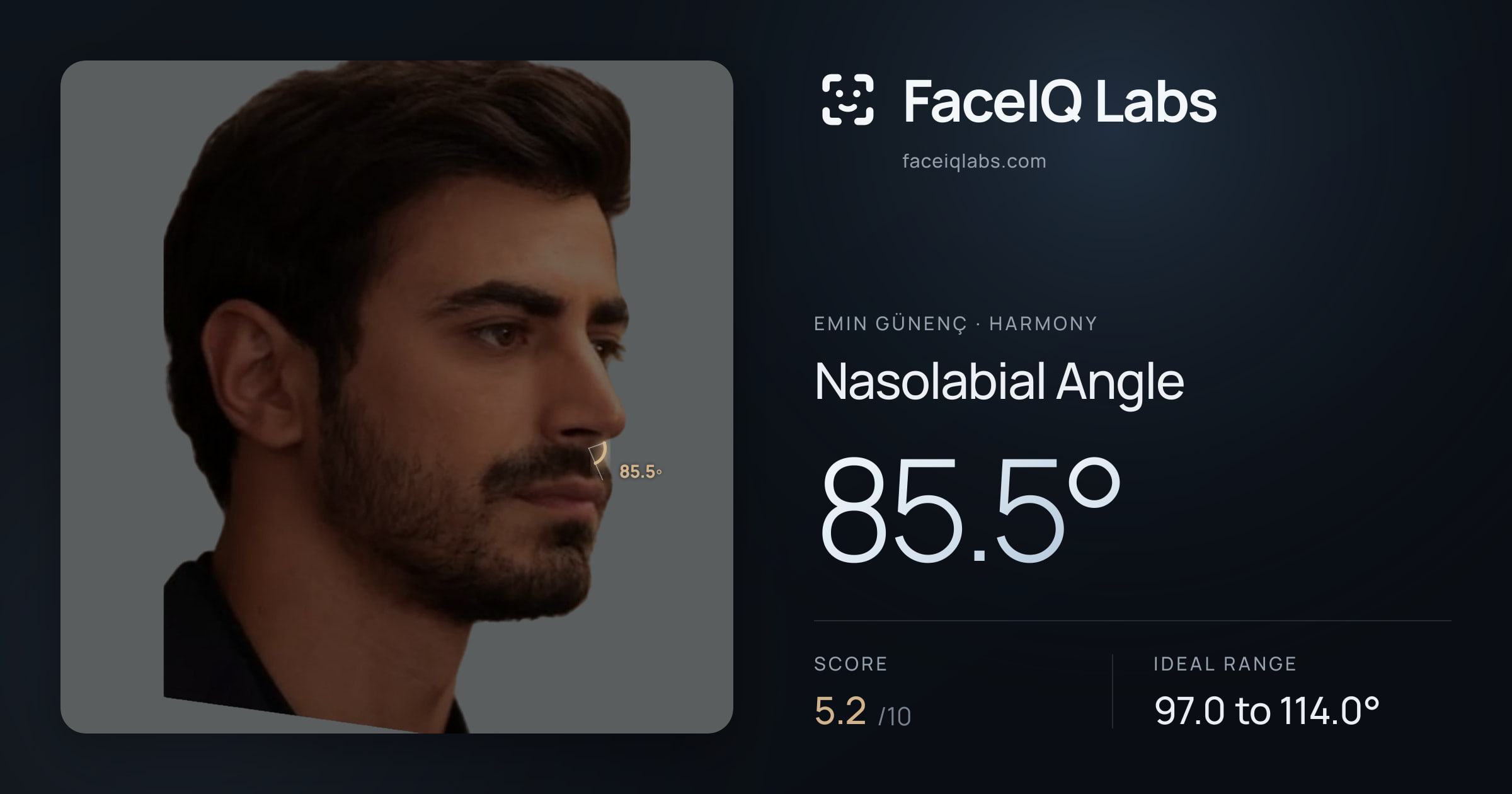 Emin Günenç Nasolabial Angle: 85.5°, drawn on the photo