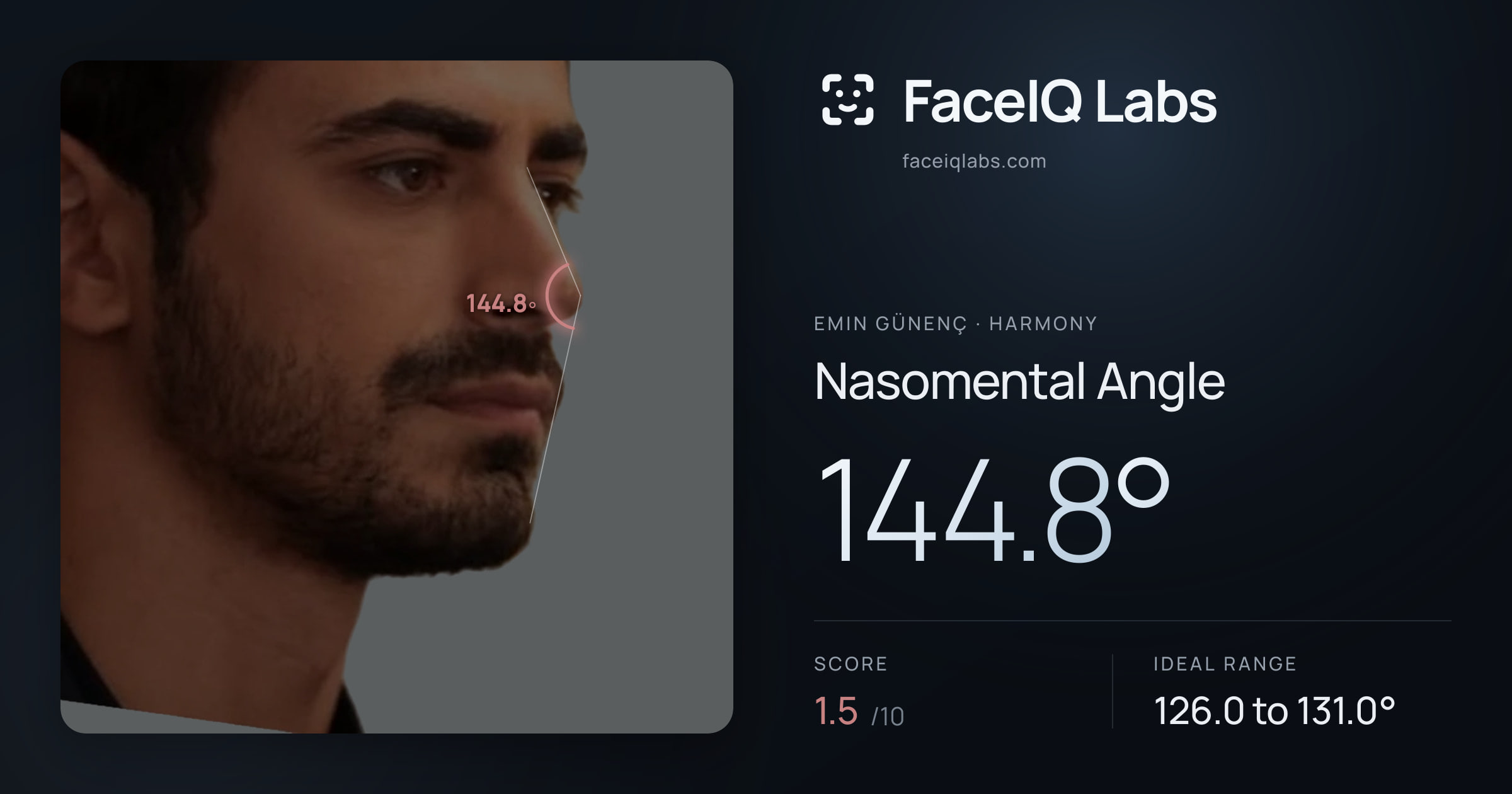 Emin Günenç Nasomental Angle: 144.8°, drawn on the photo