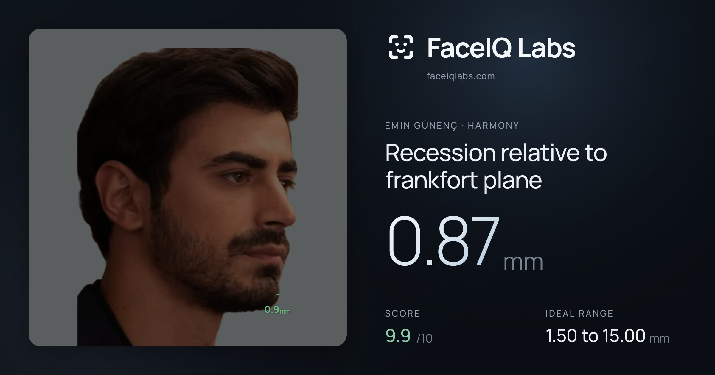 Emin Günenç Recession relative to frankfort plane: 0.87mm, drawn on the photo