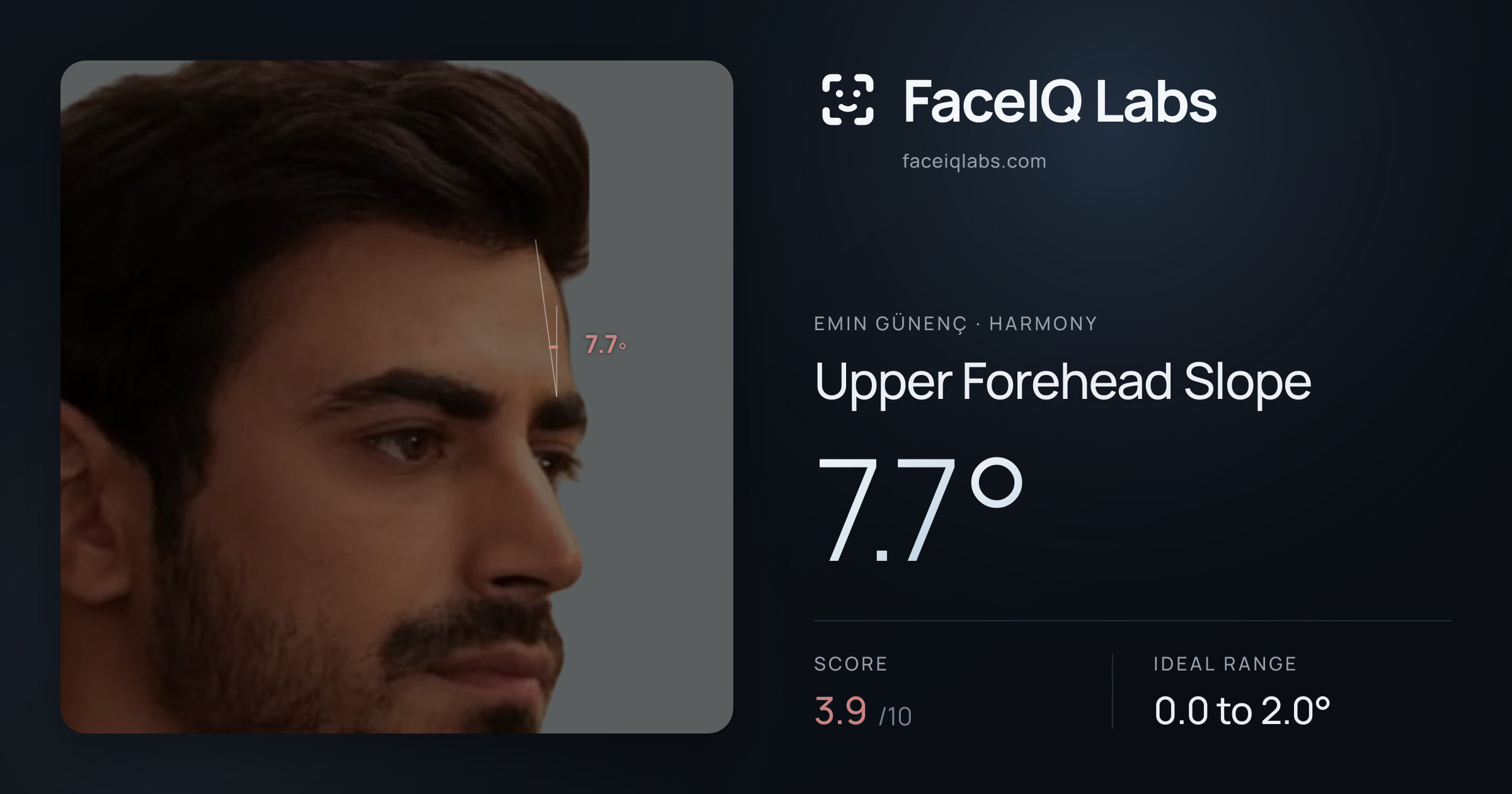 Emin Günenç Upper Forehead Slope: 7.7°, drawn on the photo