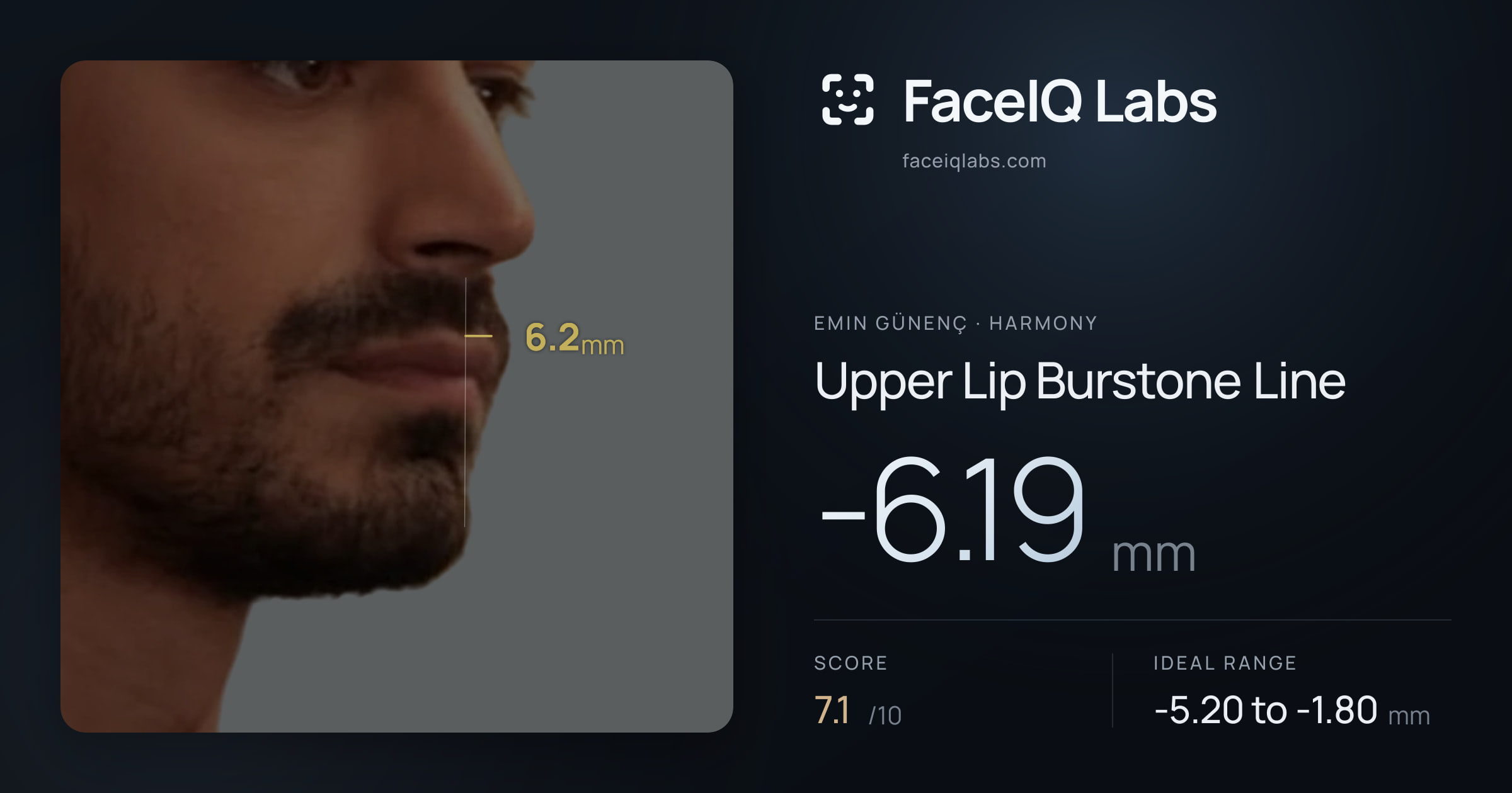 Emin Günenç Upper Lip Burstone Line: -6.19mm, drawn on the photo