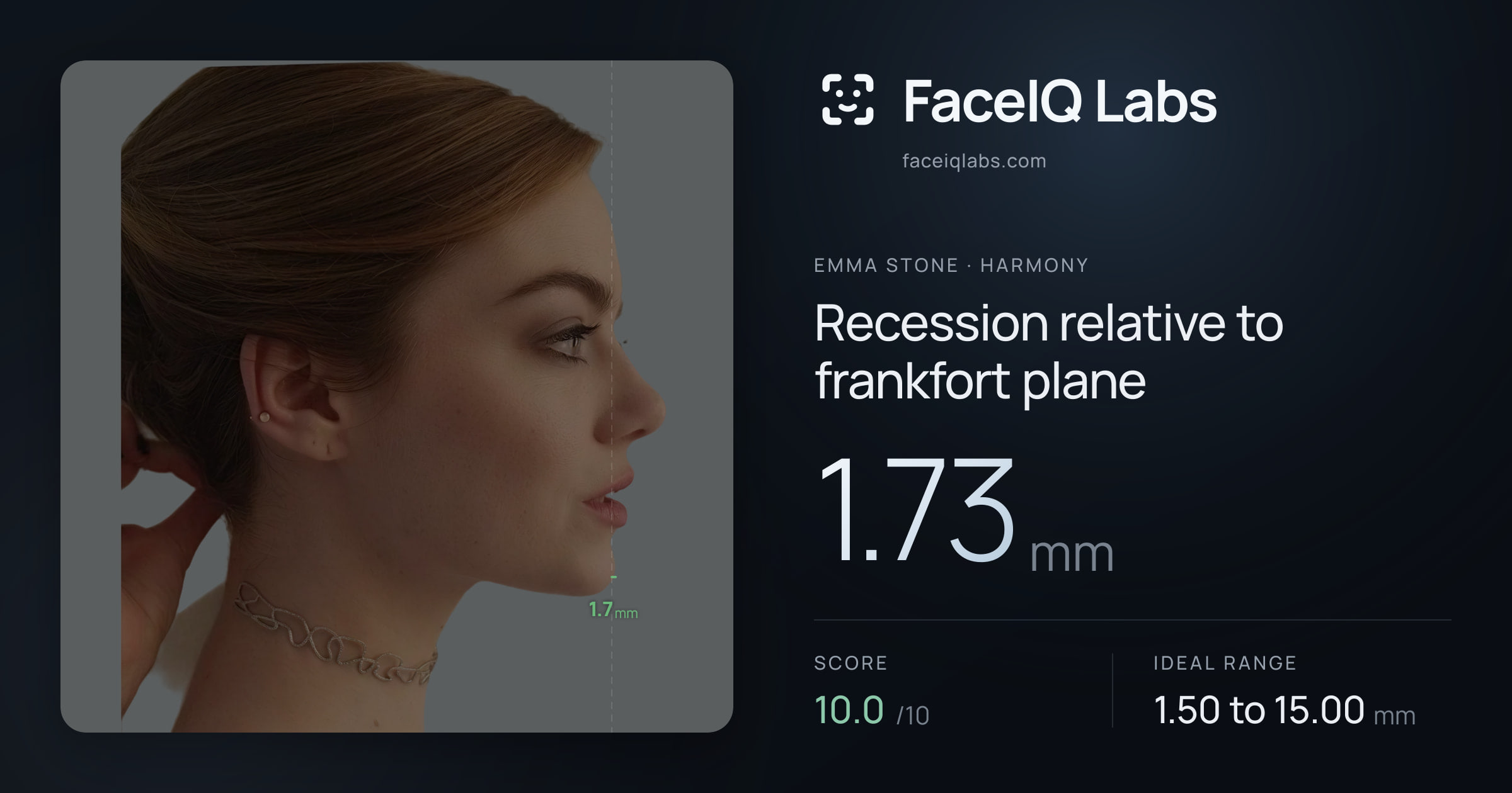 Emma Stone Recession relative to frankfort plane: 1.73mm, drawn on the photo