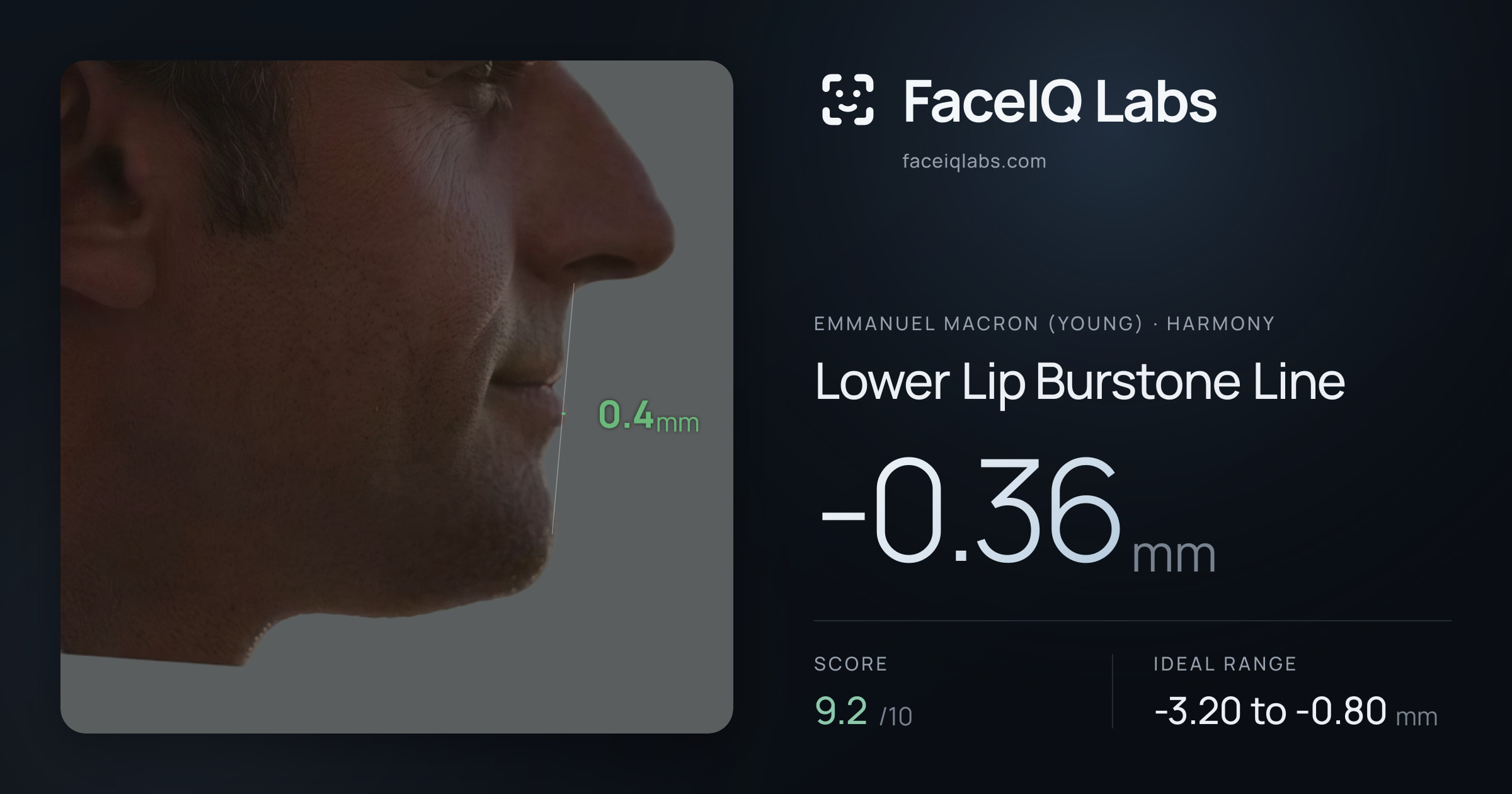 Emmanuel Macron (Young) Lower Lip Burstone Line: -0.36mm, drawn on the photo