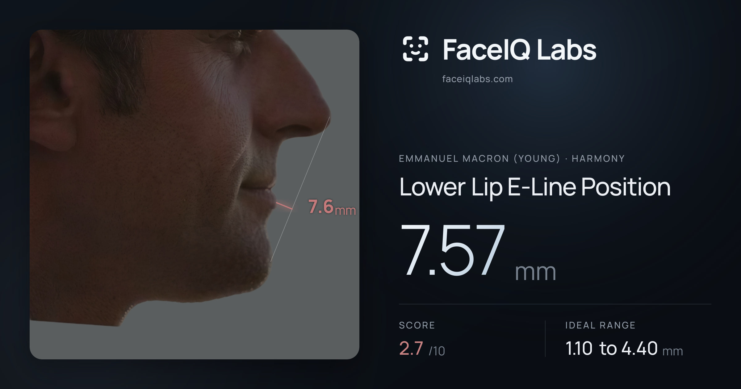 Emmanuel Macron (Young) Lower Lip E-Line Position: 7.57mm, drawn on the photo