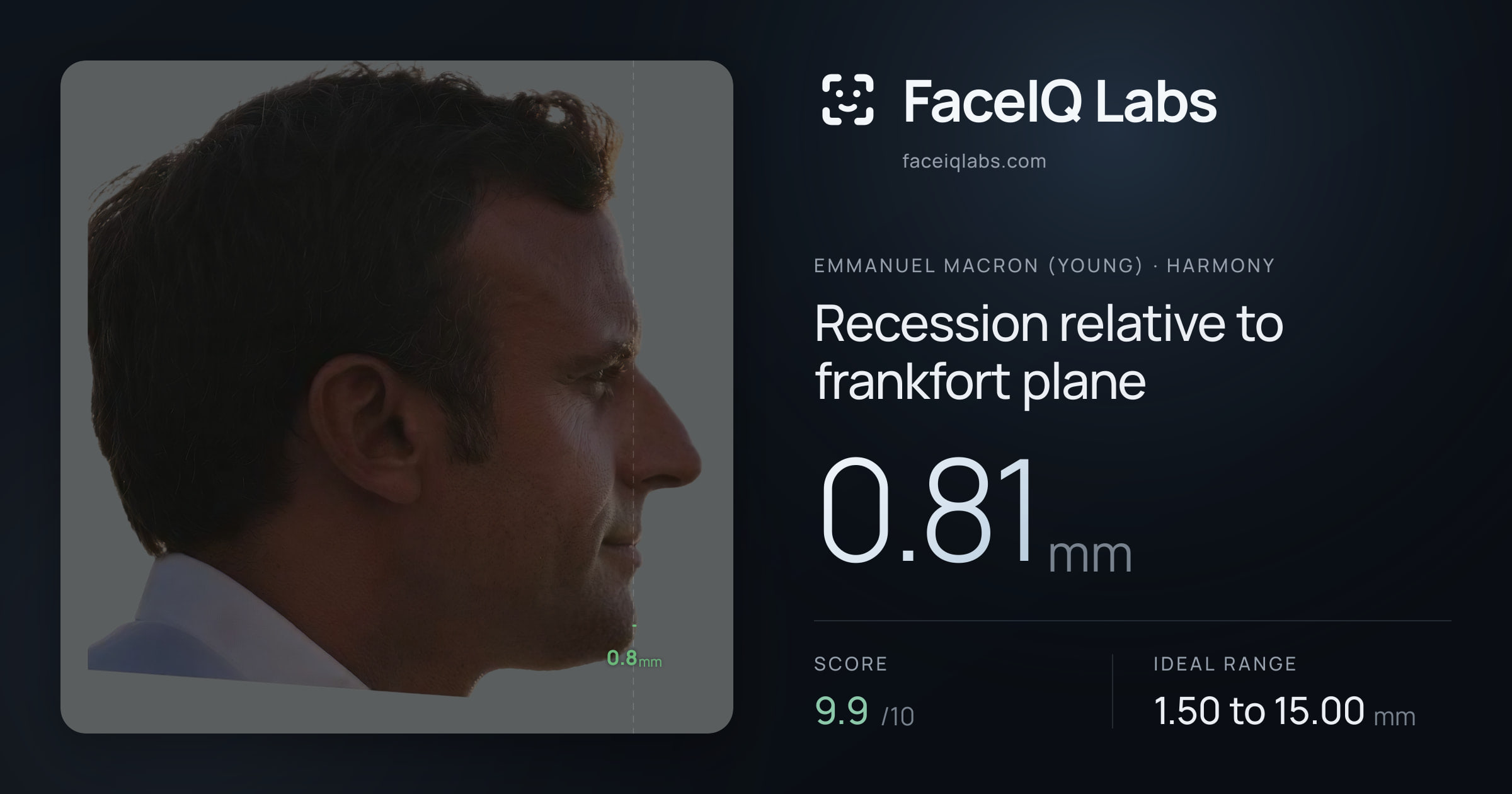 Emmanuel Macron (Young) Recession relative to frankfort plane: 0.81mm, drawn on the photo