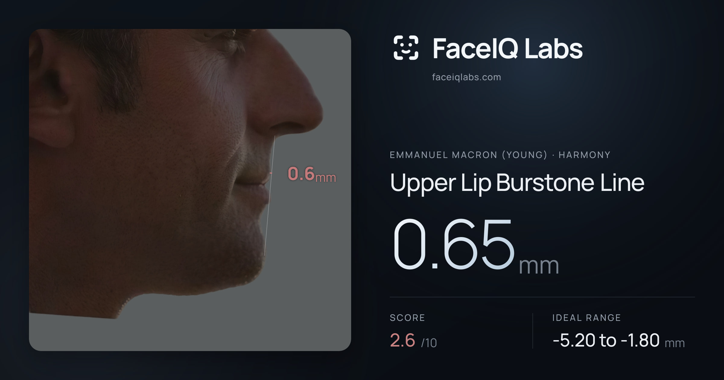 Emmanuel Macron (Young) Upper Lip Burstone Line: 0.65mm, drawn on the photo