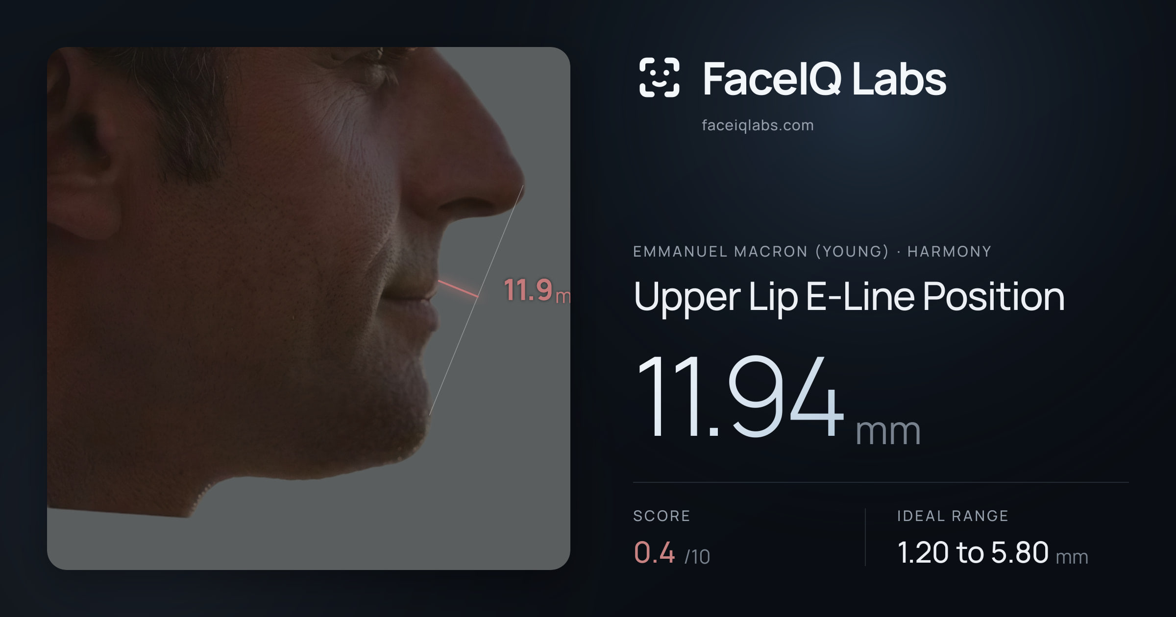 Emmanuel Macron (Young) Upper Lip E-Line Position: 11.94mm, drawn on the photo