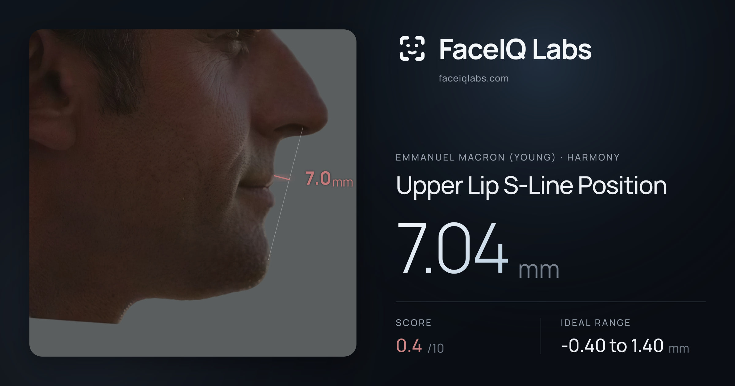 Emmanuel Macron (Young) Upper Lip S-Line Position: 7.04mm, drawn on the photo