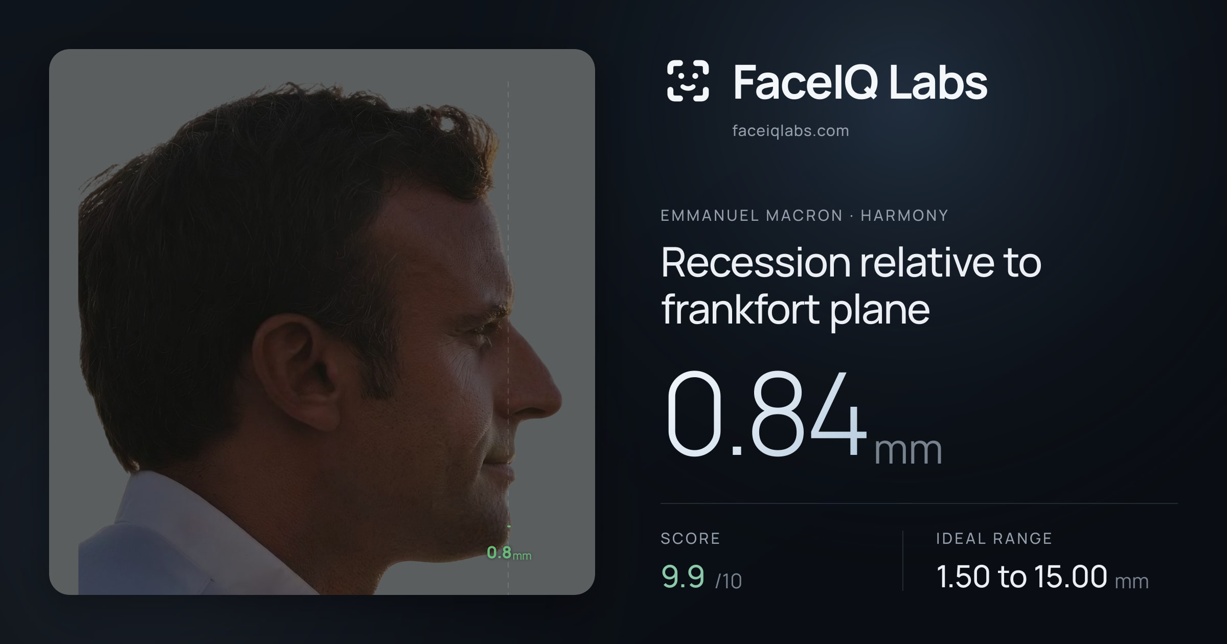 Emmanuel Macron Recession relative to frankfort plane: 0.84mm, drawn on the photo