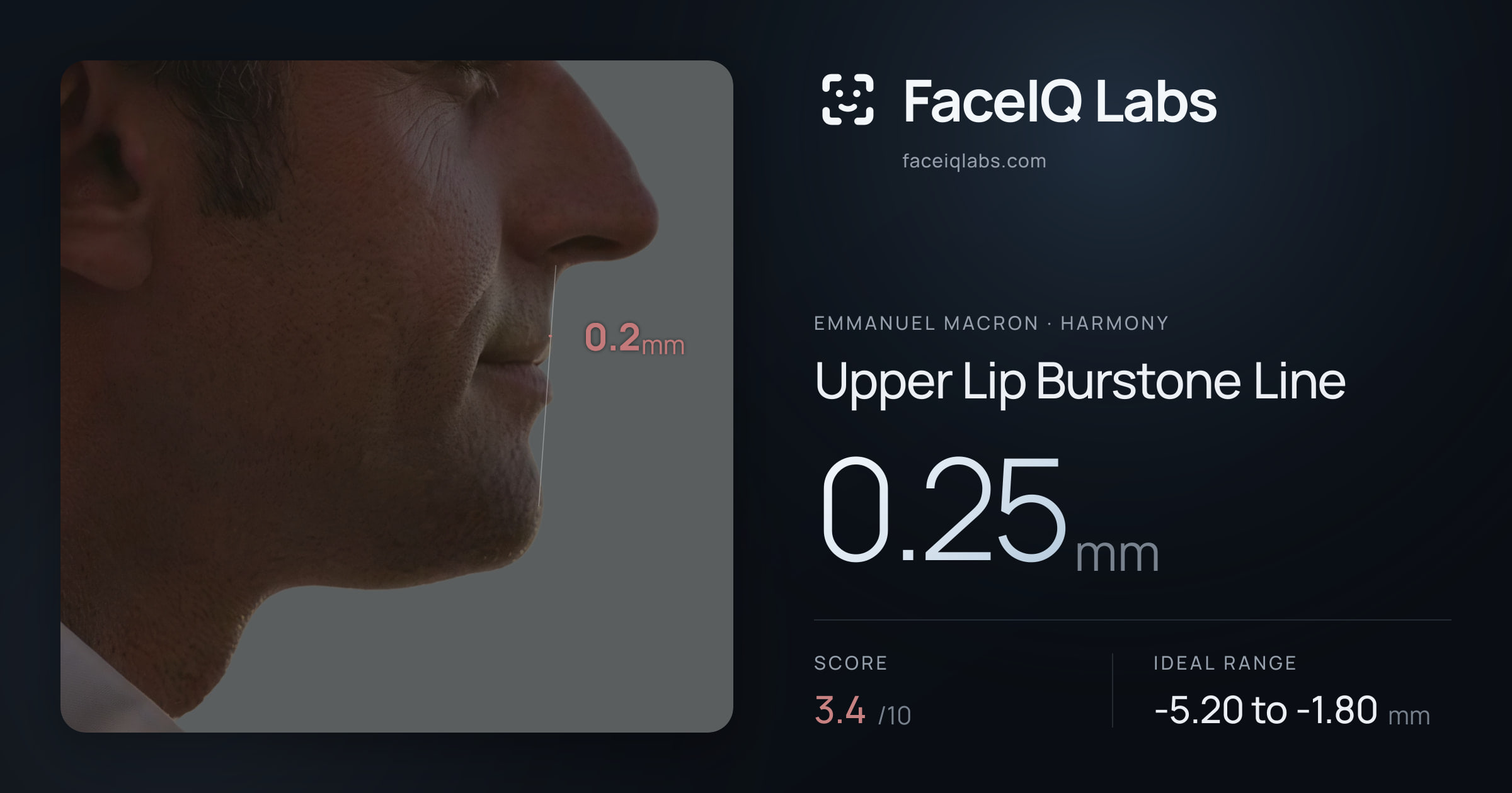 Emmanuel Macron Upper Lip Burstone Line: 0.25mm, drawn on the photo