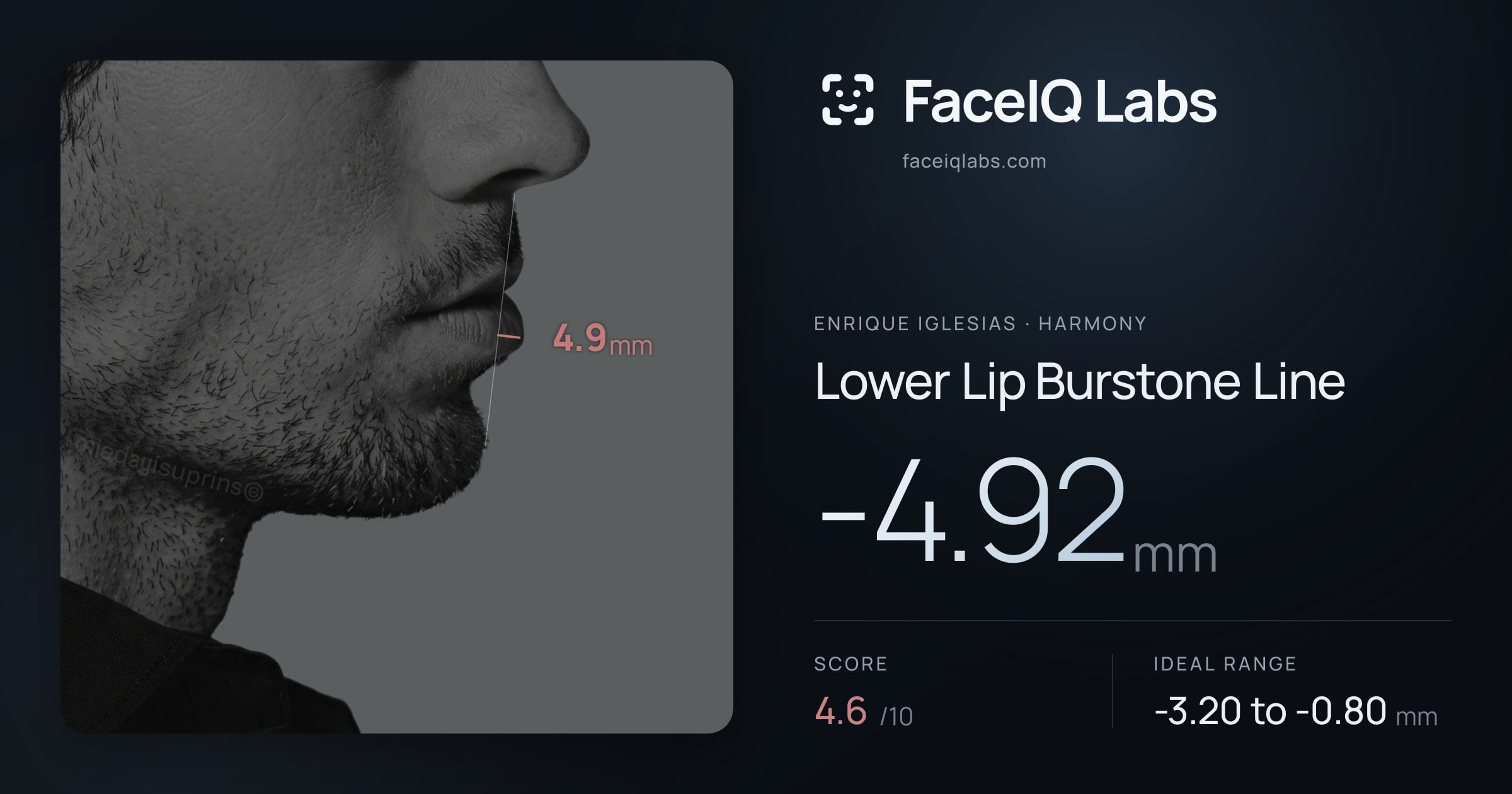 Enrique Iglesias Lower Lip Burstone Line: -4.92mm, drawn on the photo