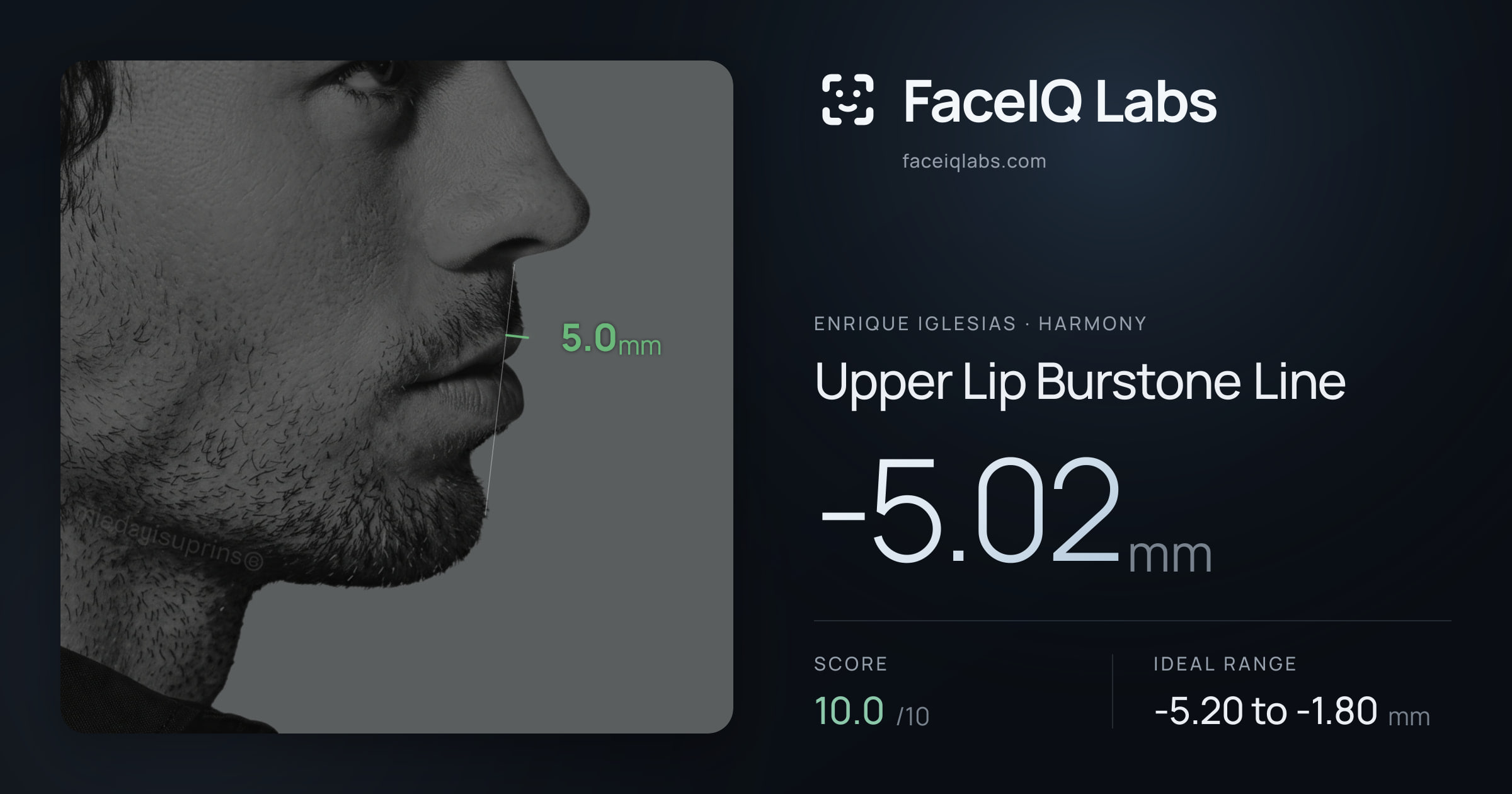 Enrique Iglesias Upper Lip Burstone Line: -5.02mm, drawn on the photo