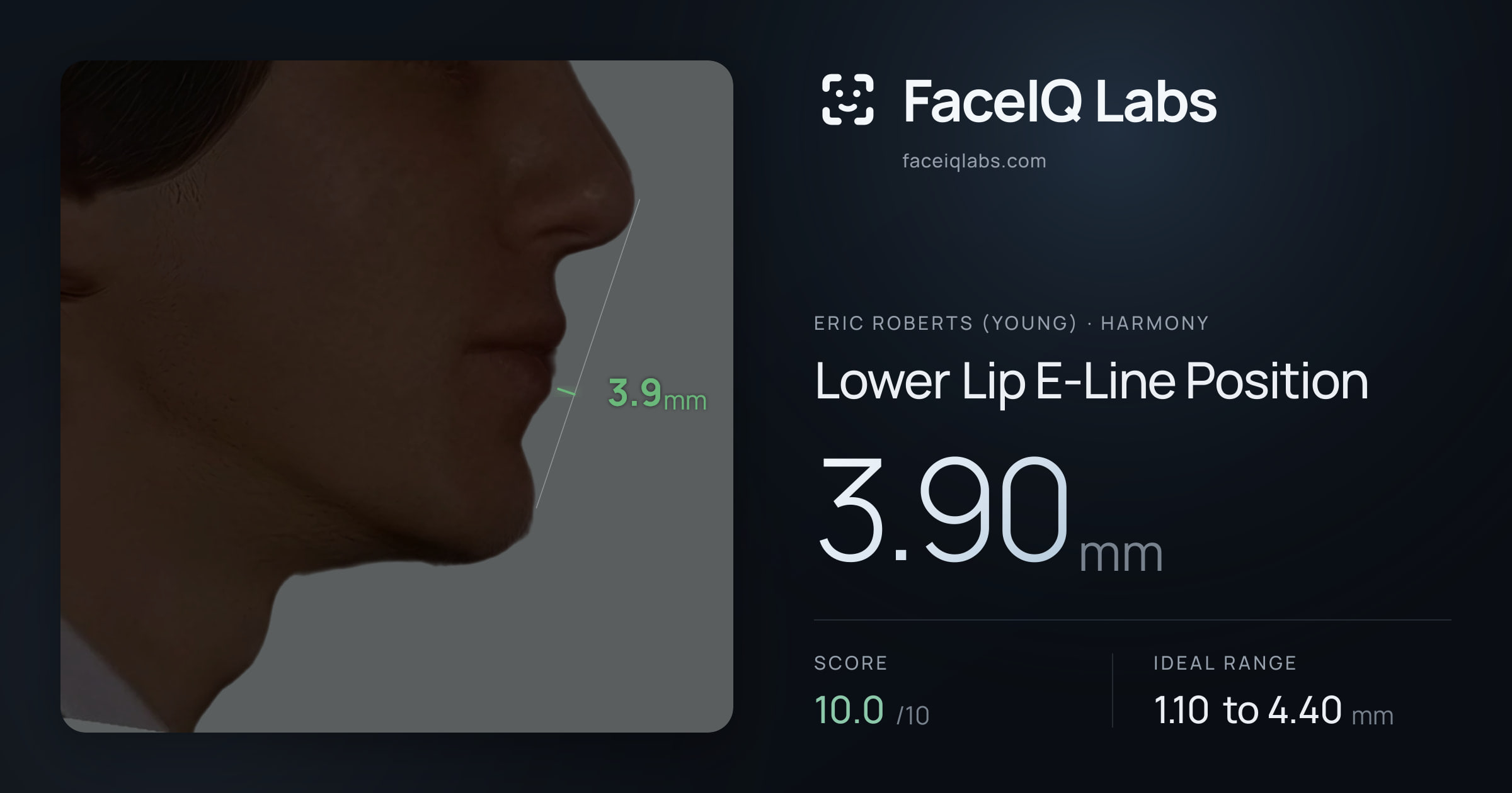 Eric Roberts (Young) Lower Lip E-Line Position: 3.90mm, drawn on the photo