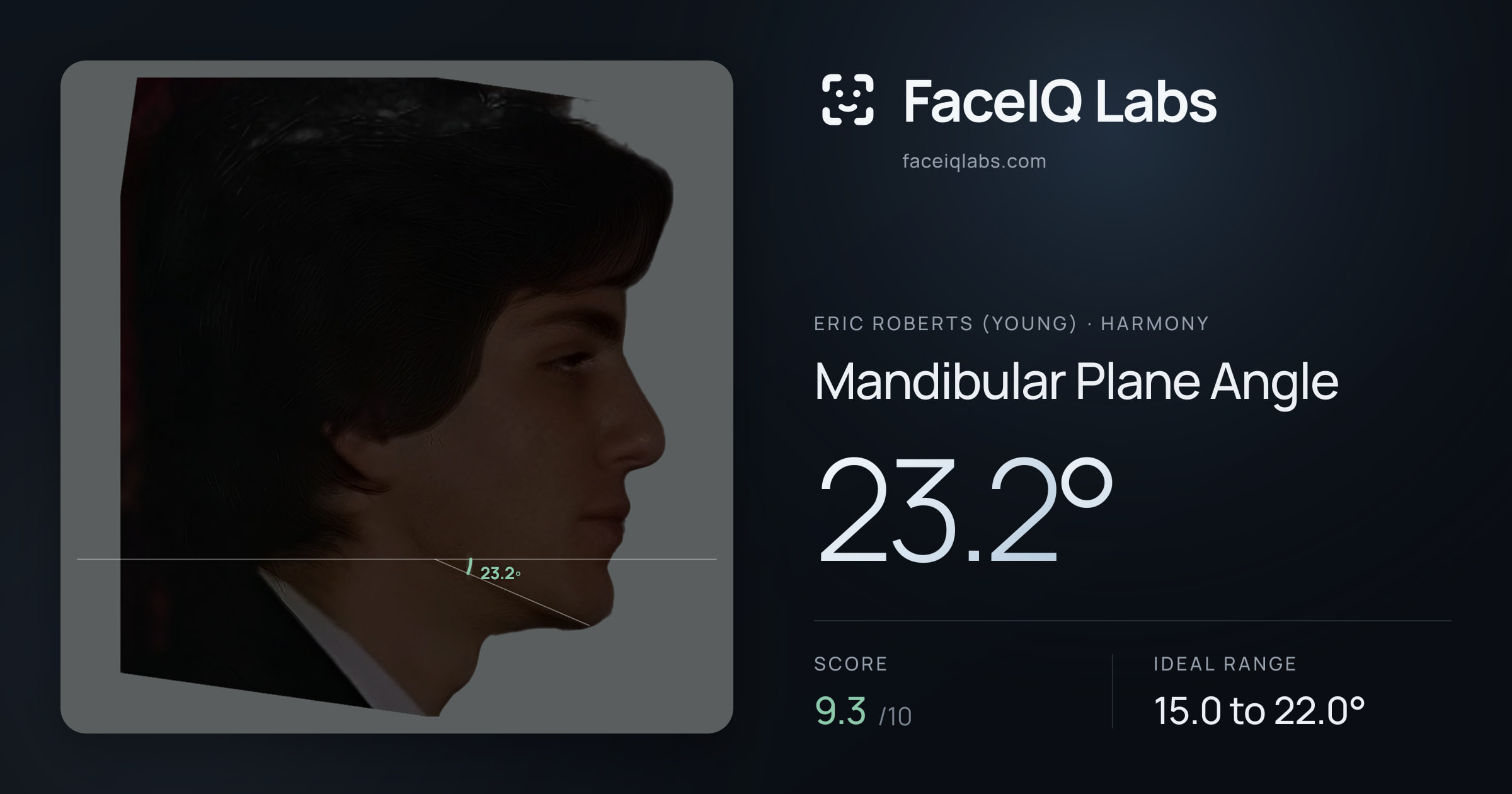 Eric Roberts (Young) Mandibular Plane Angle: 23.2°, drawn on the photo