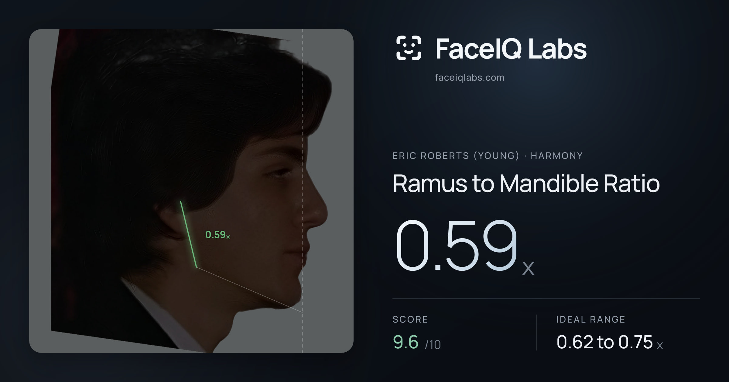 Eric Roberts (Young) Ramus to Mandible Ratio: 0.59x, drawn on the photo