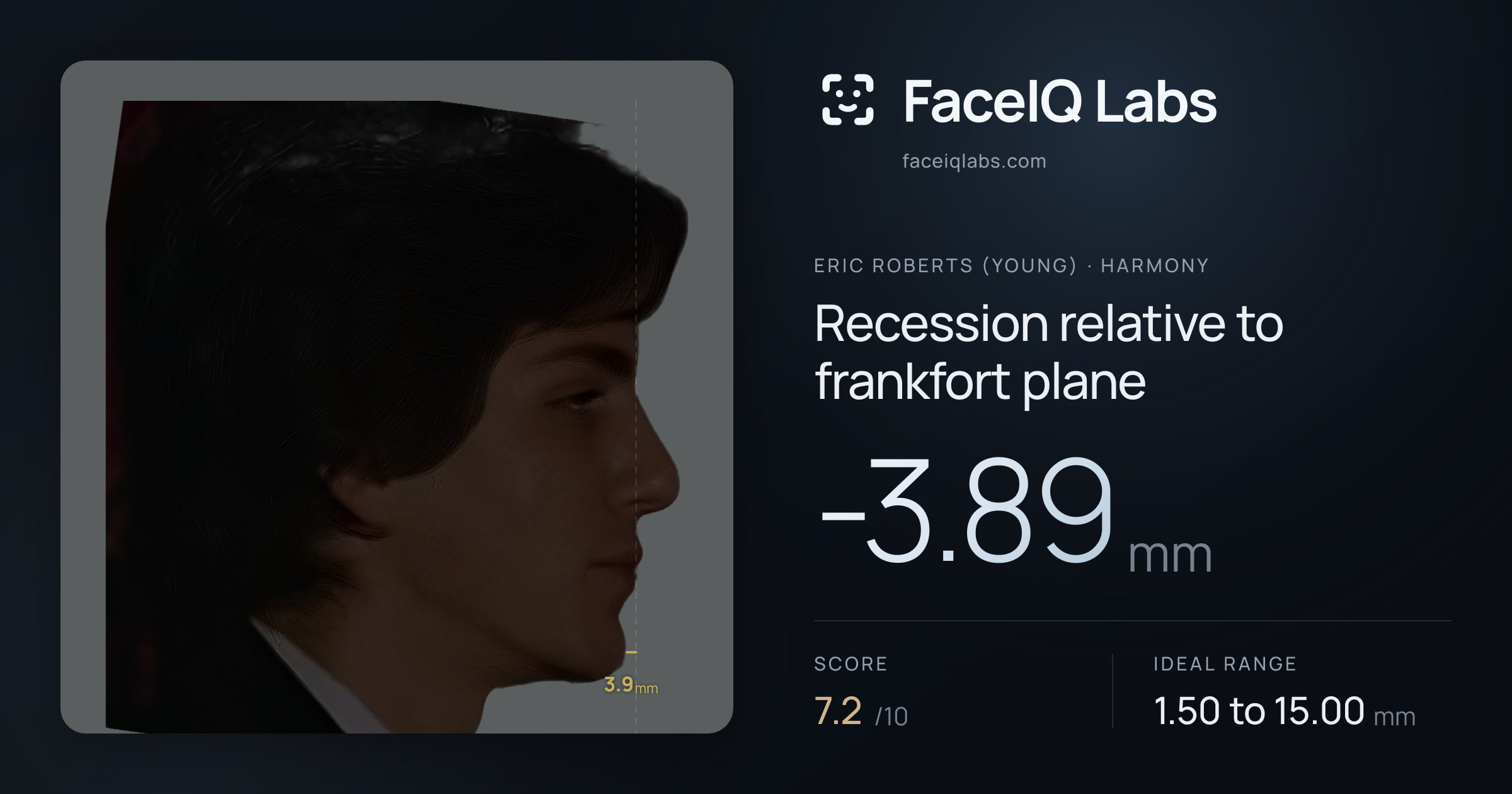 Eric Roberts (Young) Recession relative to frankfort plane: -3.89mm, drawn on the photo