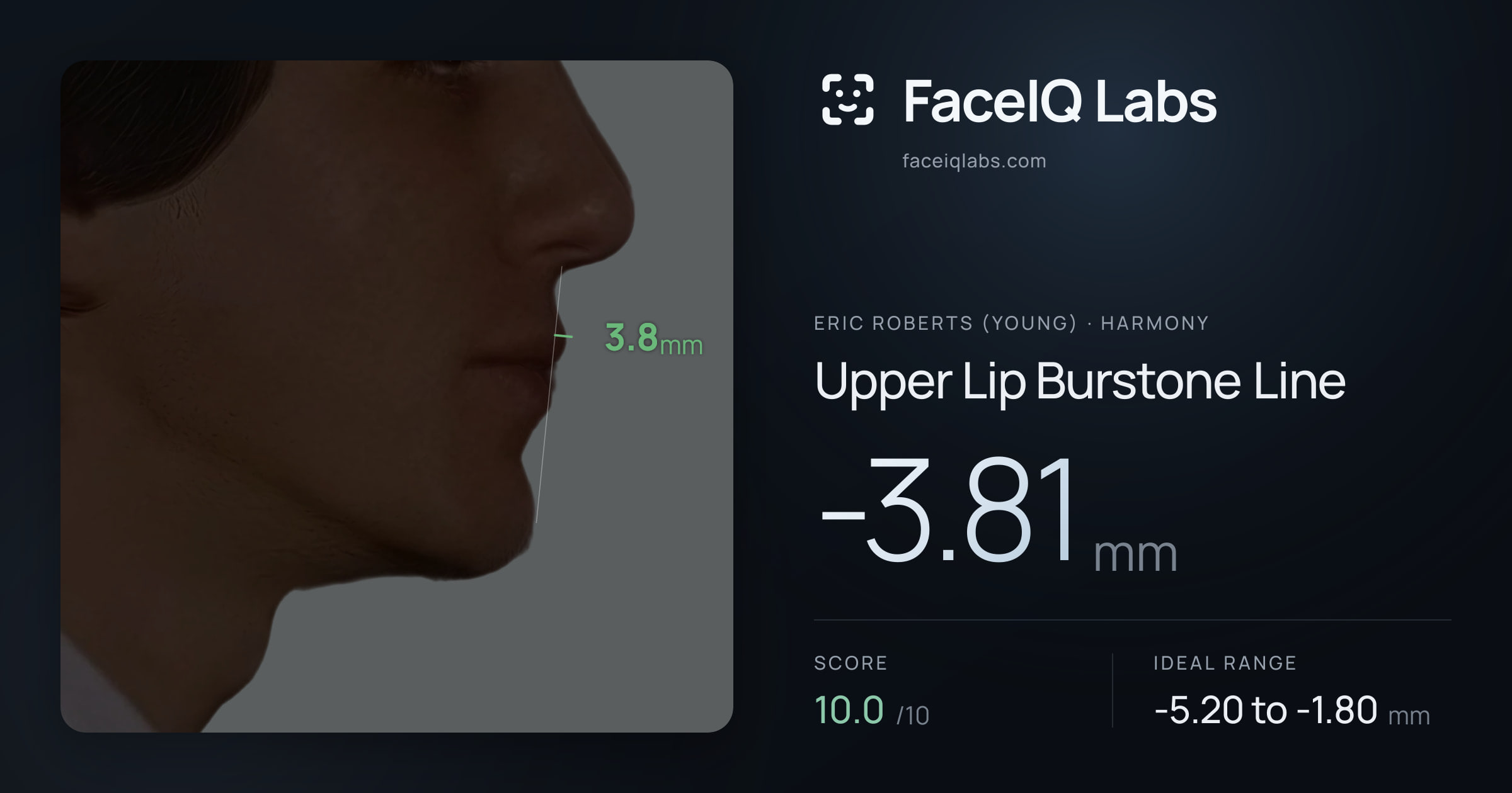 Eric Roberts (Young) Upper Lip Burstone Line: -3.81mm, drawn on the photo
