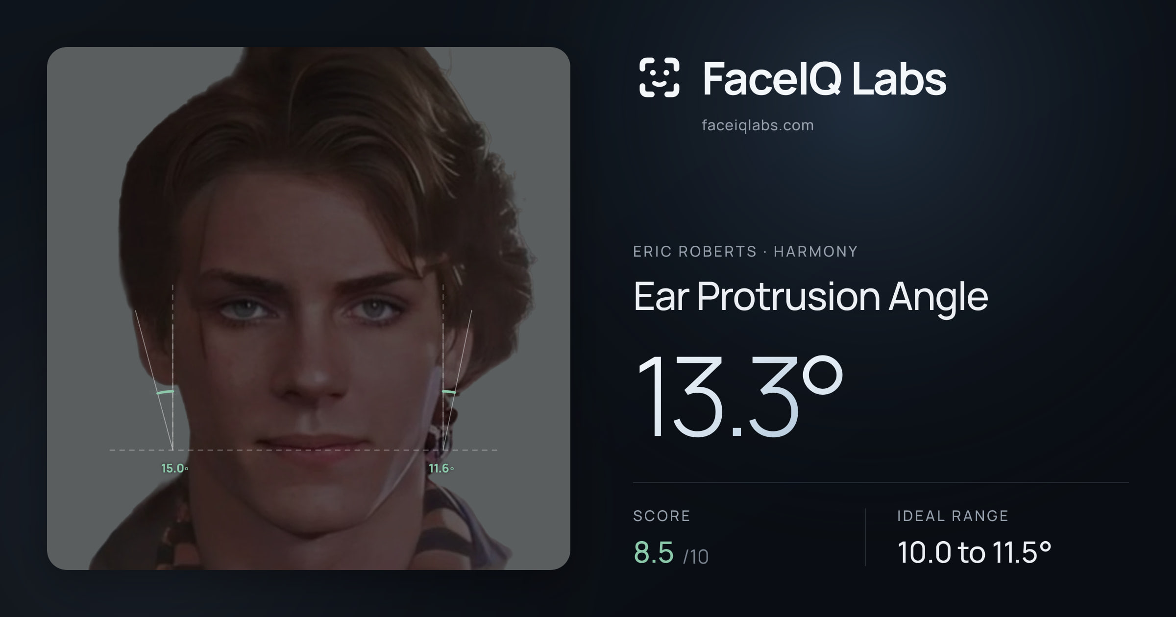 Eric Roberts Ear Protrusion Angle: 13.3°, drawn on the photo
