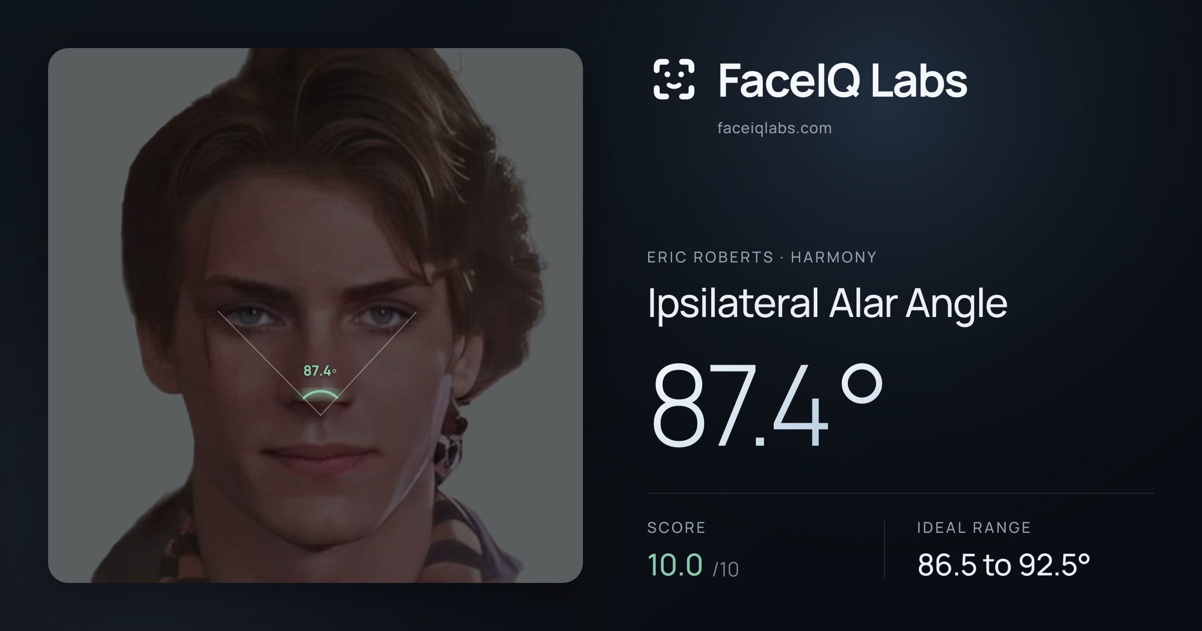 Eric Roberts Ipsilateral Alar Angle: 87.4°, drawn on the photo