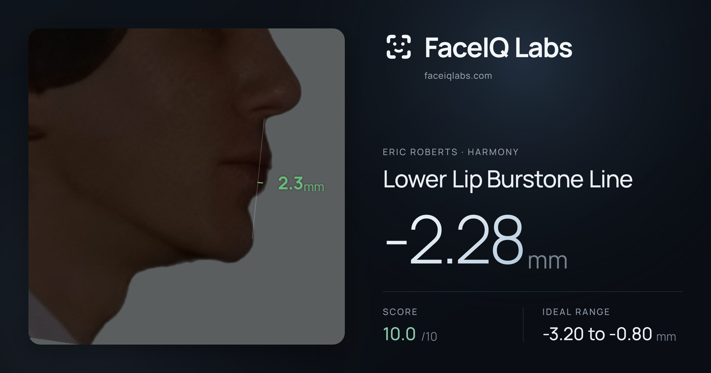 Eric Roberts Lower Lip Burstone Line: -2.28mm, drawn on the photo