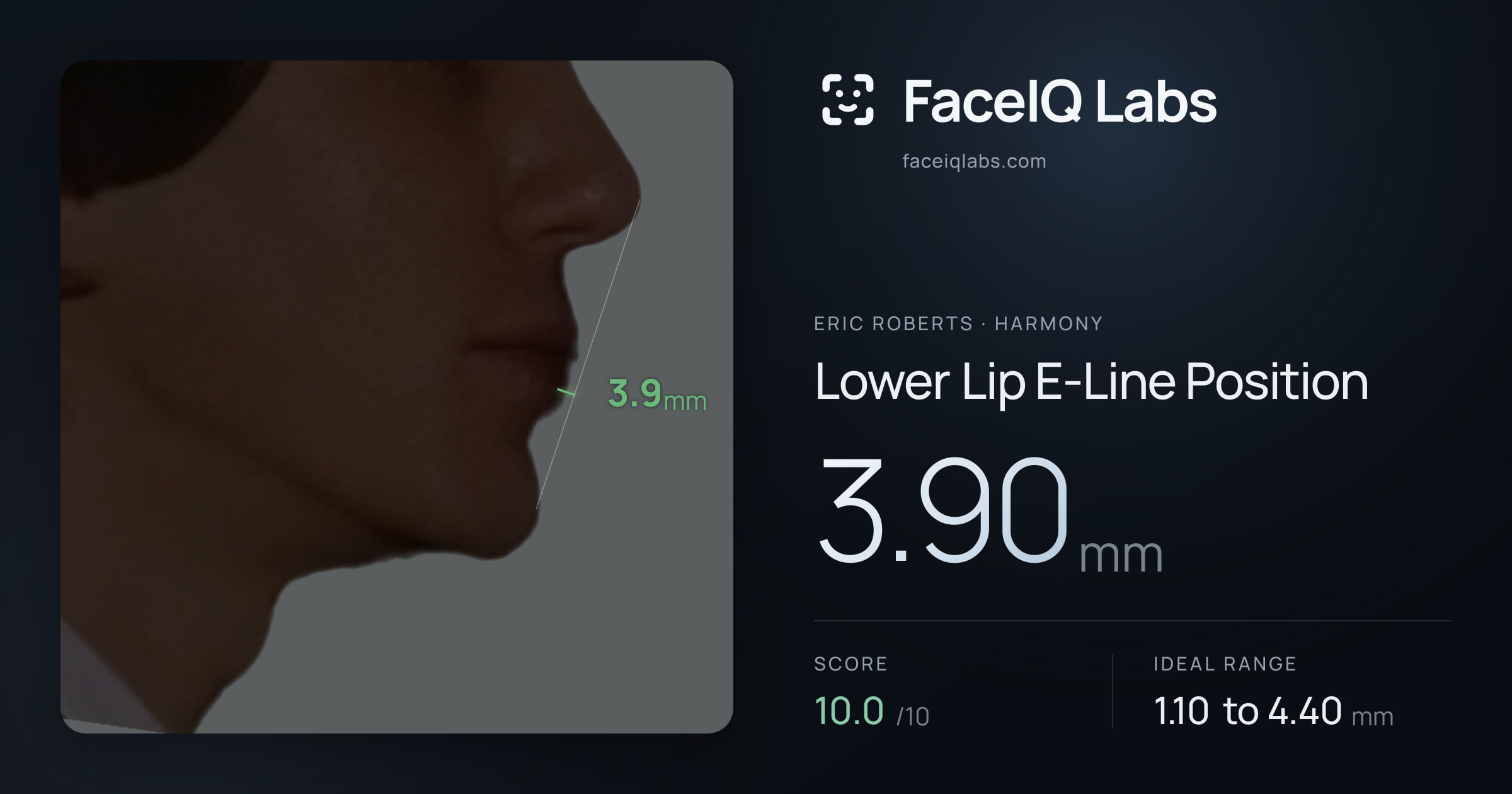 Eric Roberts Lower Lip E-Line Position: 3.90mm, drawn on the photo