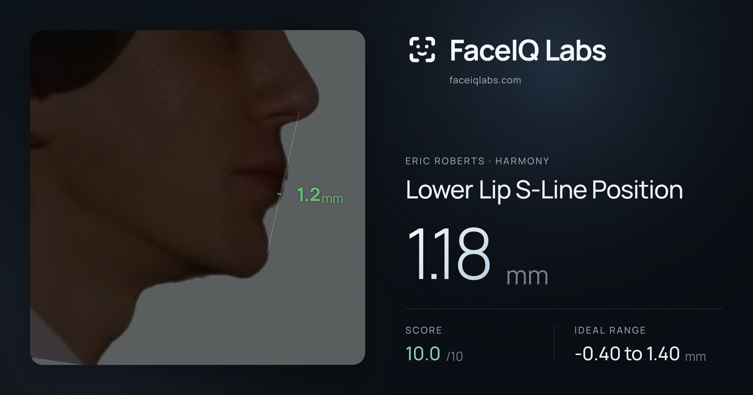 Eric Roberts Lower Lip S-Line Position: 1.18mm, drawn on the photo