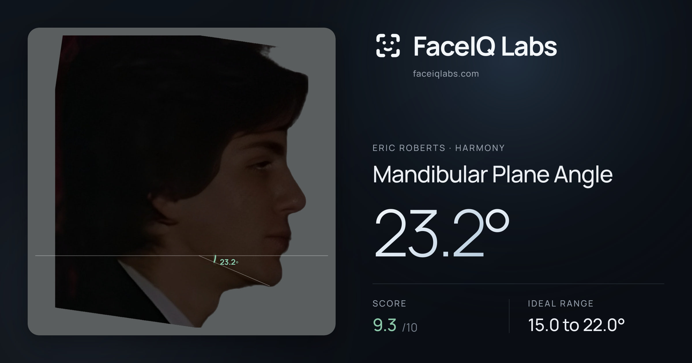Eric Roberts Mandibular Plane Angle: 23.2°, drawn on the photo