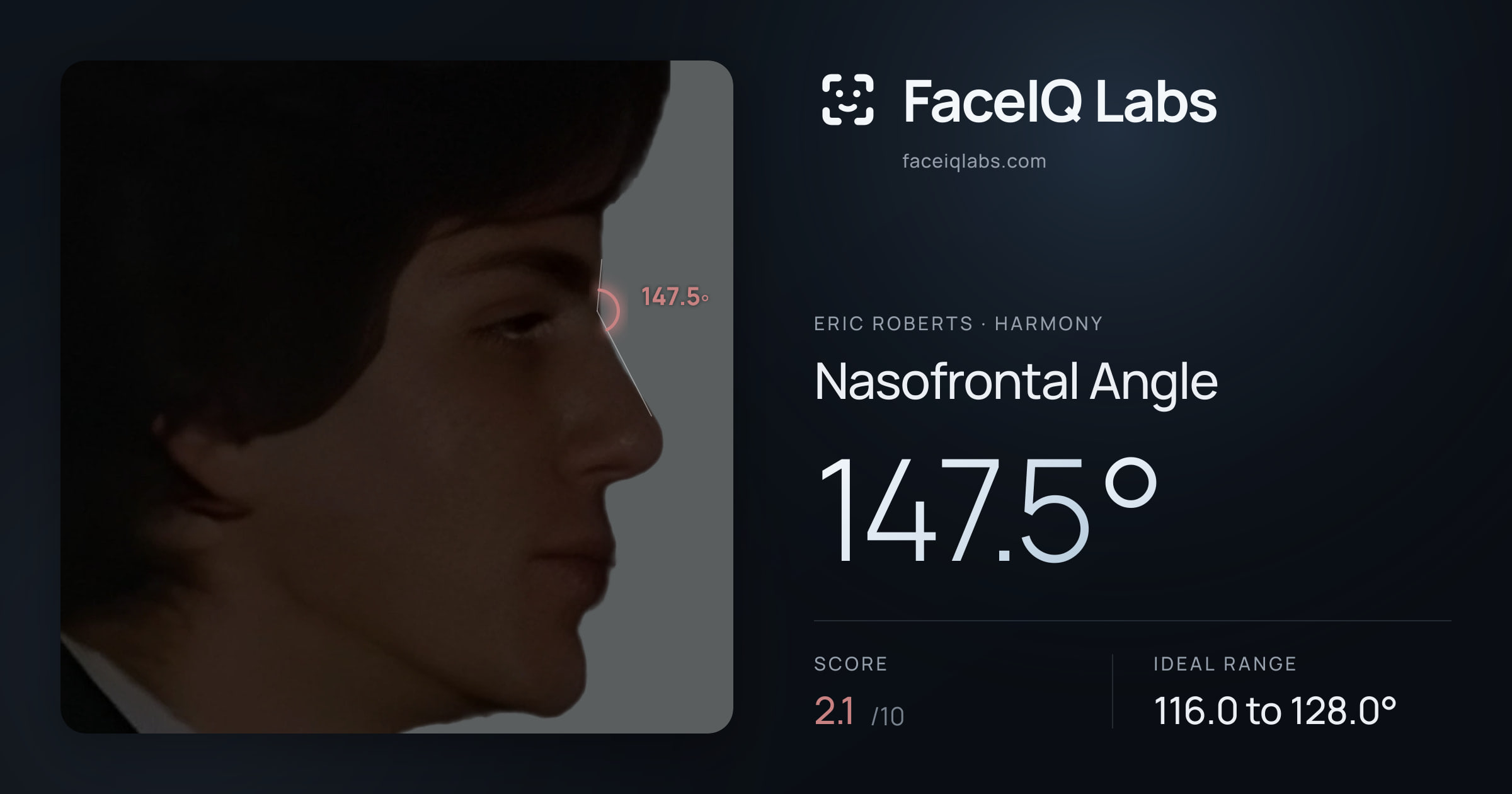 Eric Roberts Nasofrontal Angle: 147.5°, drawn on the photo