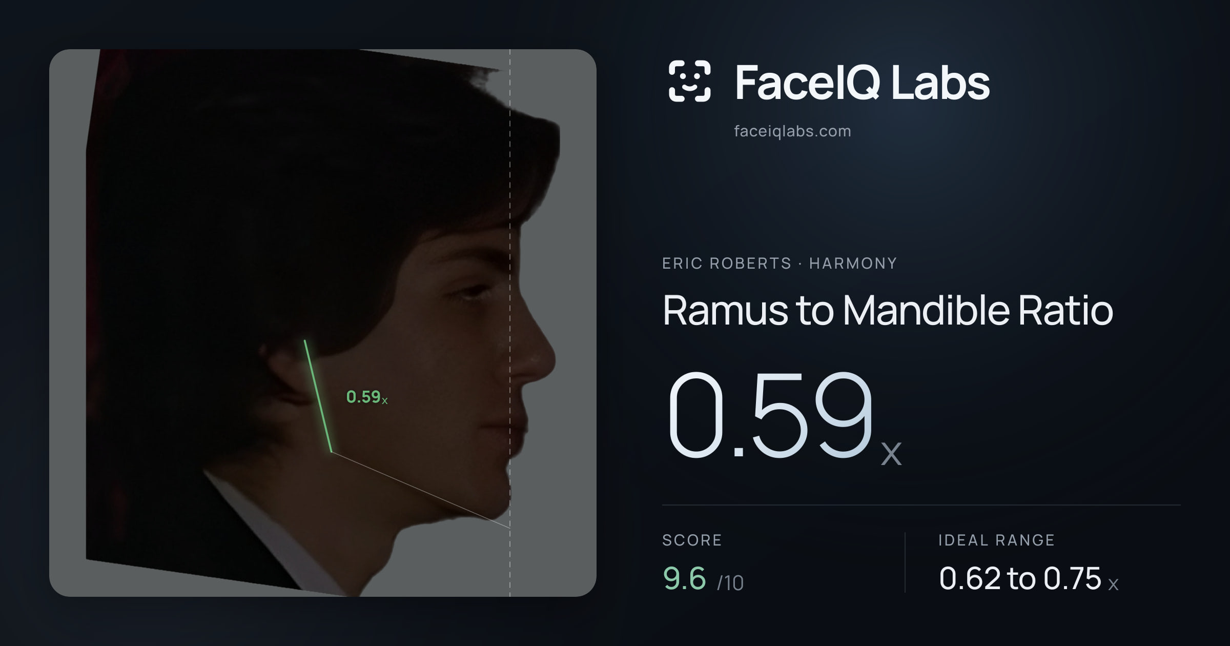 Eric Roberts Ramus to Mandible Ratio: 0.59x, drawn on the photo