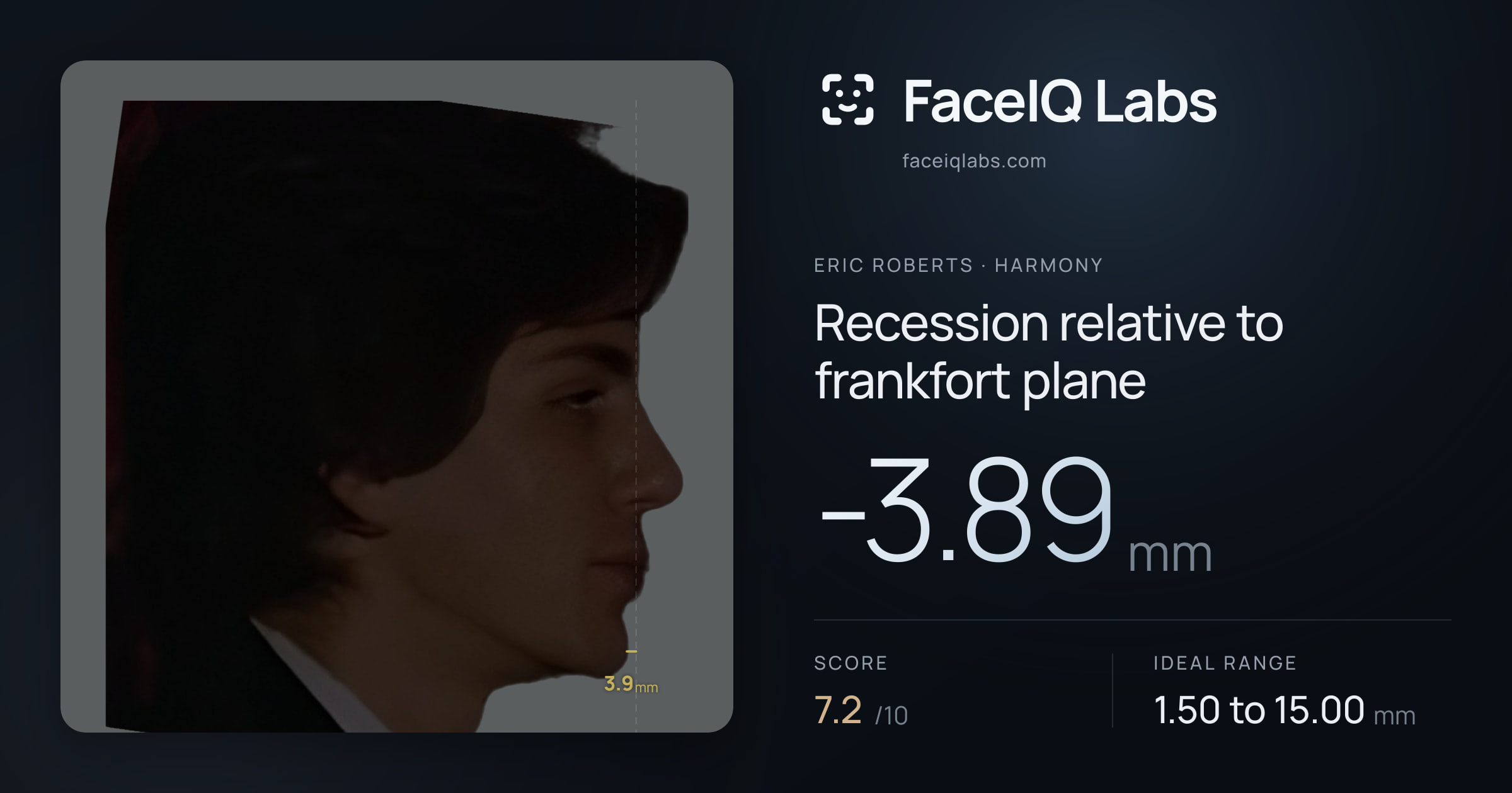 Eric Roberts Recession relative to frankfort plane: -3.89mm, drawn on the photo