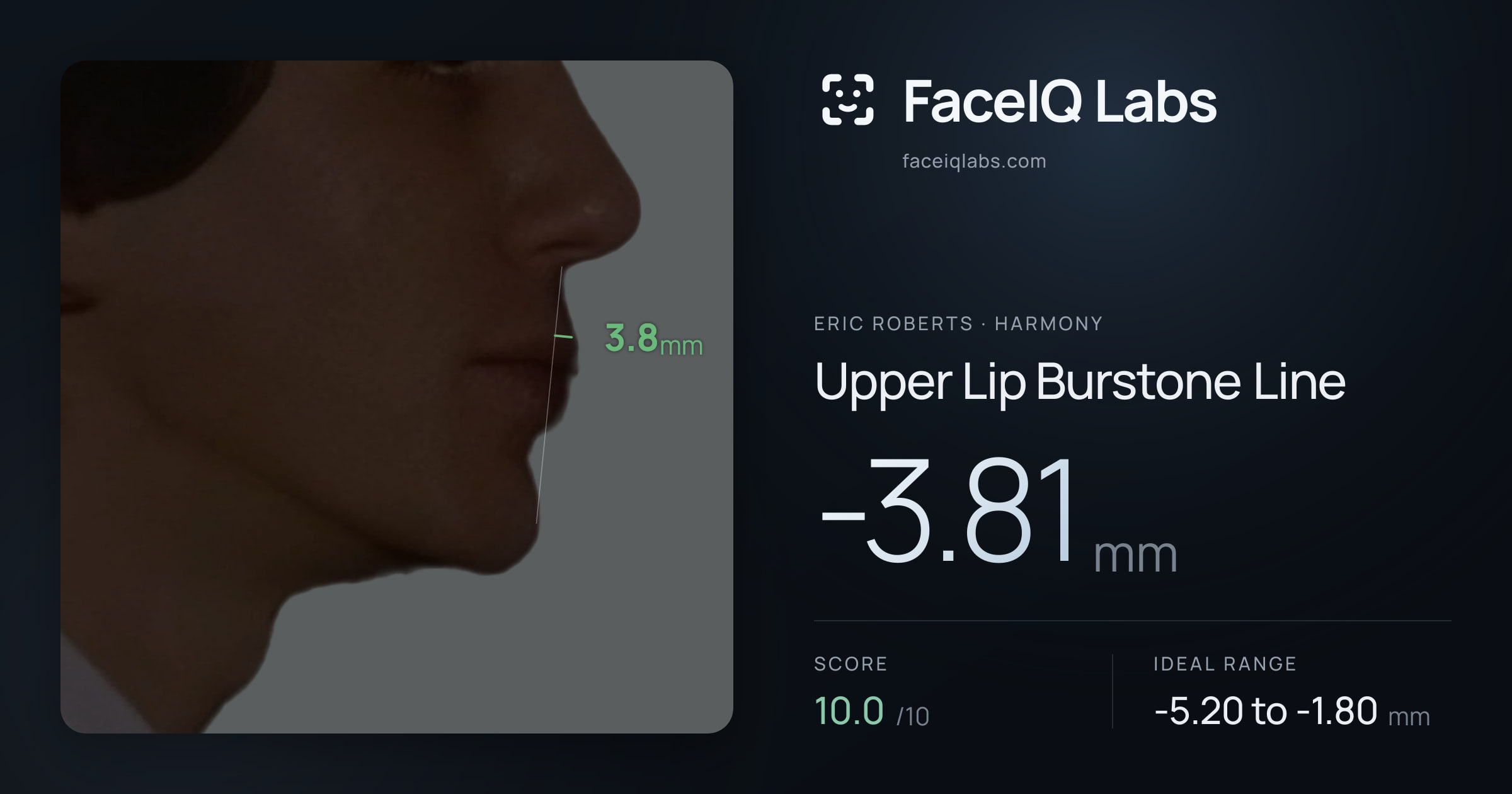 Eric Roberts Upper Lip Burstone Line: -3.81mm, drawn on the photo
